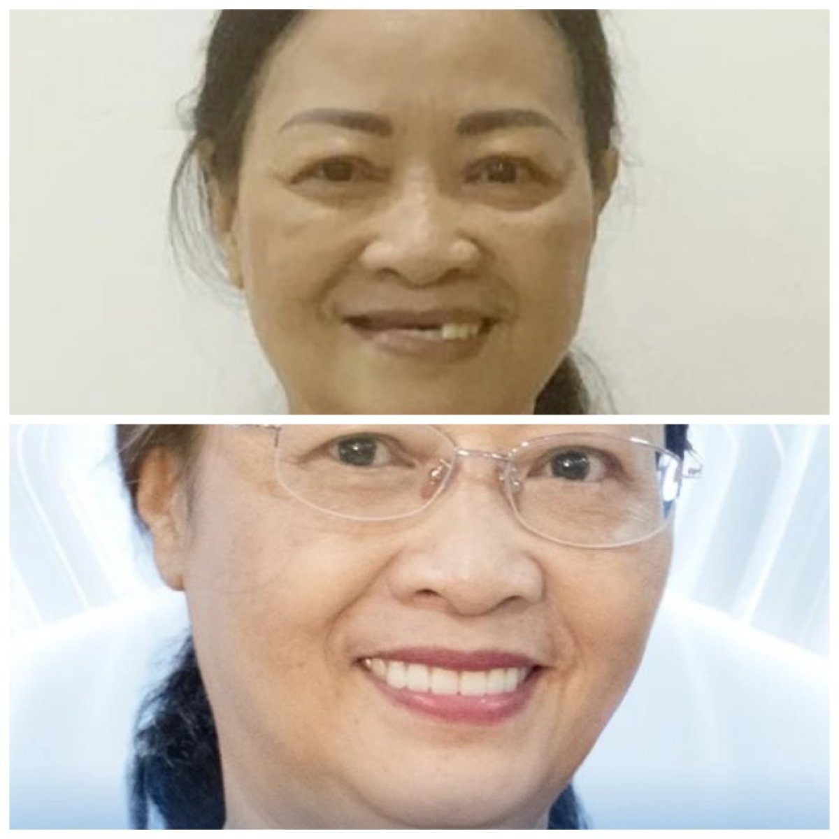 قبل وبعد زراعة الأسنان مع التاج في مركز Lac Viet Intech Dental Center، نتيجة استعادة الابتسامة