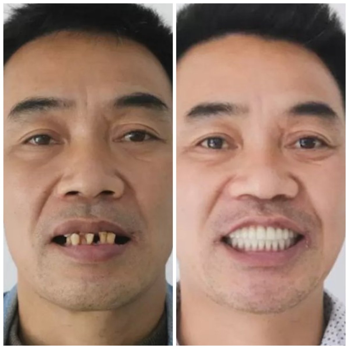 Résultat avant/après implants All-on-4 au Lac Viet Intech Dental Center, sourire restauré