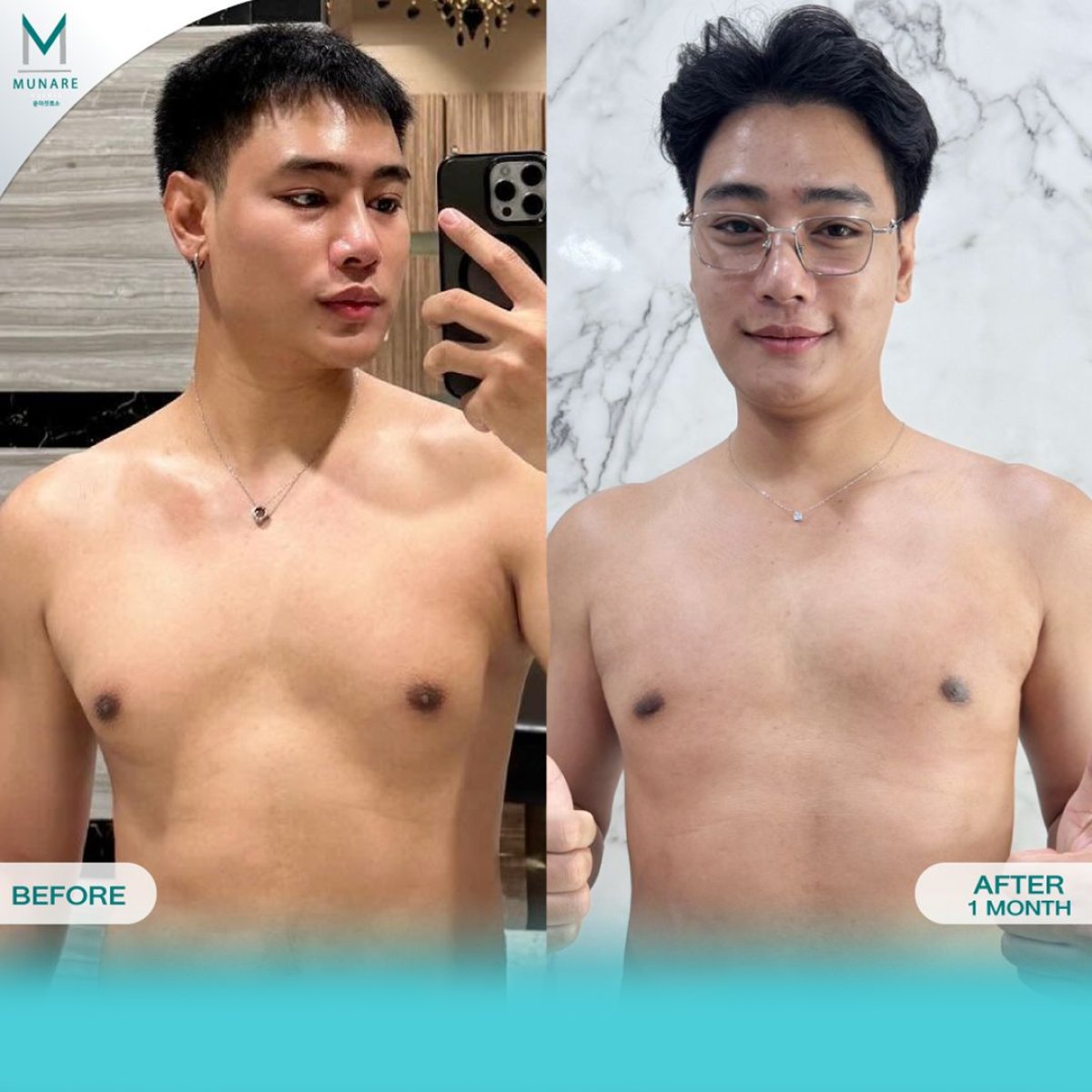 Resultados antes y después de cirugía de ginecomastia en Munare Clinic Chiangmai, pecho plano