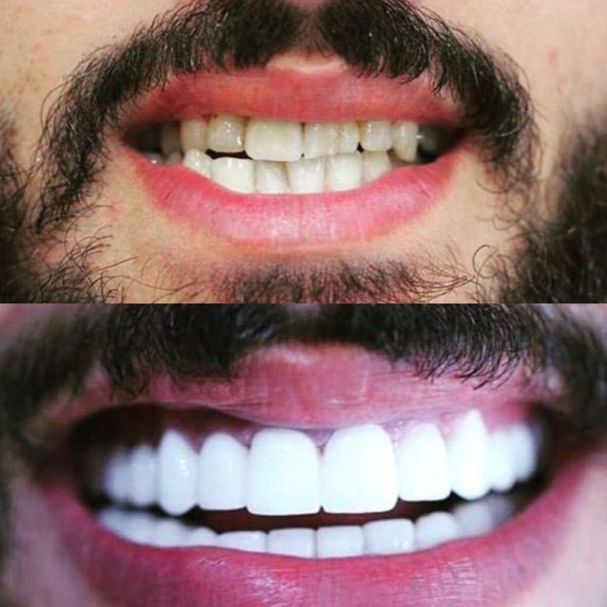 Antes y después de carillas en Hegazy Dental Clinic: transformación de sonrisa y dientes más blancos
