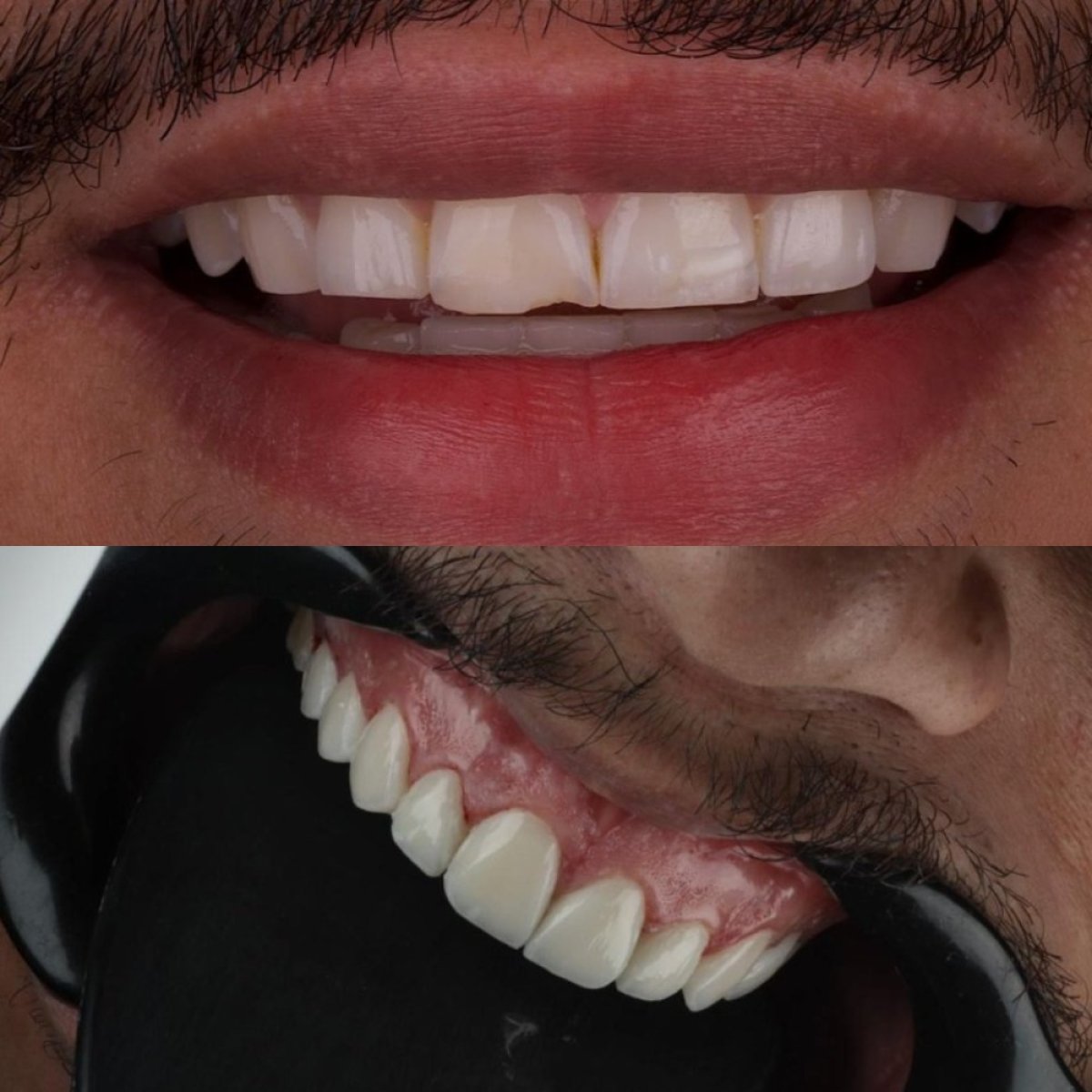 Antes y después de carillas dentales en Hegazy Dental Clinic – sonrisa mejorada y dientes más blancos