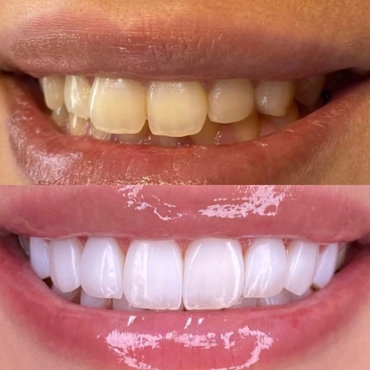 До та після встановлення вінірів у Hegazy Dental Clinic – перетворення посмішки, білі зуби