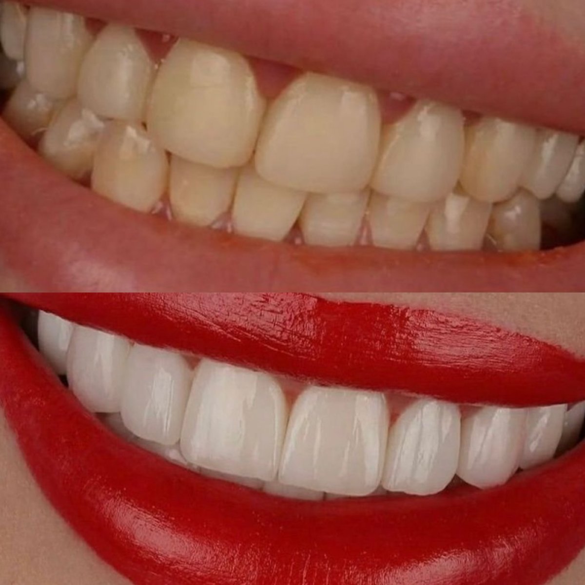 Resultados antes y después de smile makeover en Hegazy Dental Clinic: blanqueamiento y carillas