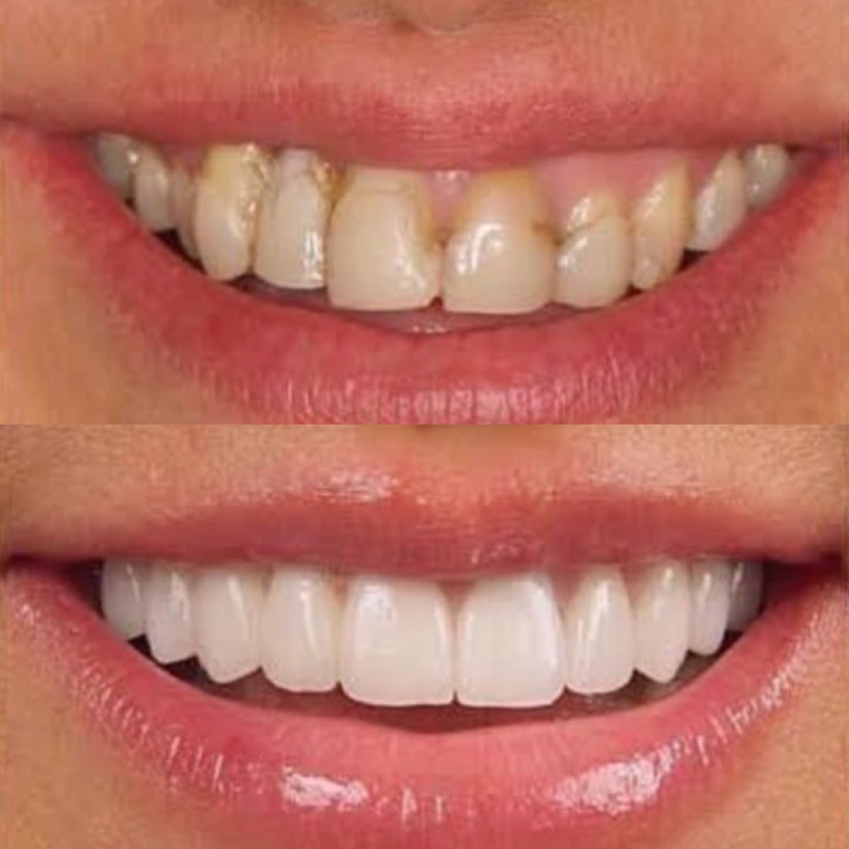 Resultados de antes y después de smile makeover en Hegazy Dental Clinic – dientes blancos y parejos