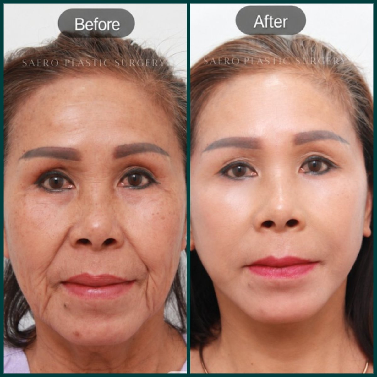 نتائج شد الوجه العميق قبل وبعد في SAERO Plastic Surgery، تجديد شباب الوجه