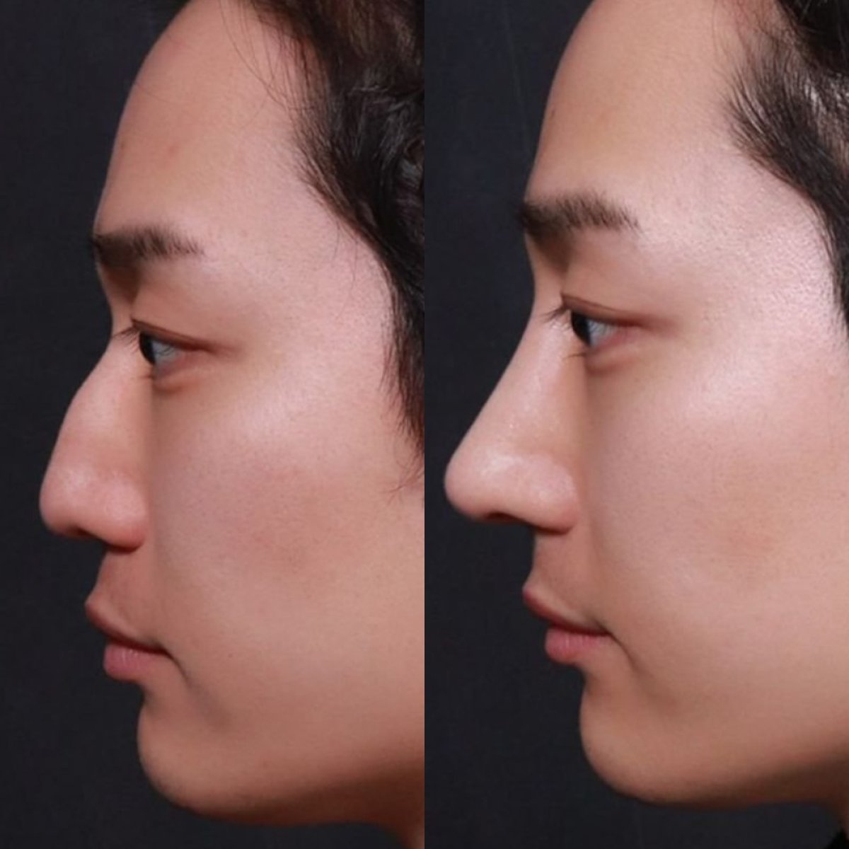 Resultados de rinoplastia antes y después en VG Plastic Surgery, perfil nasal mejorado
