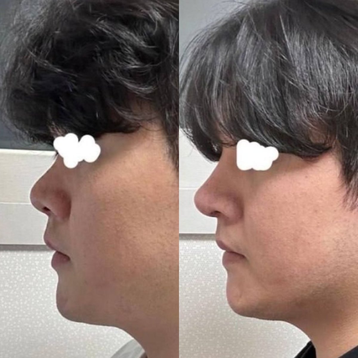 نتائج تجميل الأنف قبل وبعد في VG Plastic Surgery، تحسين شكل الأنف والملامح