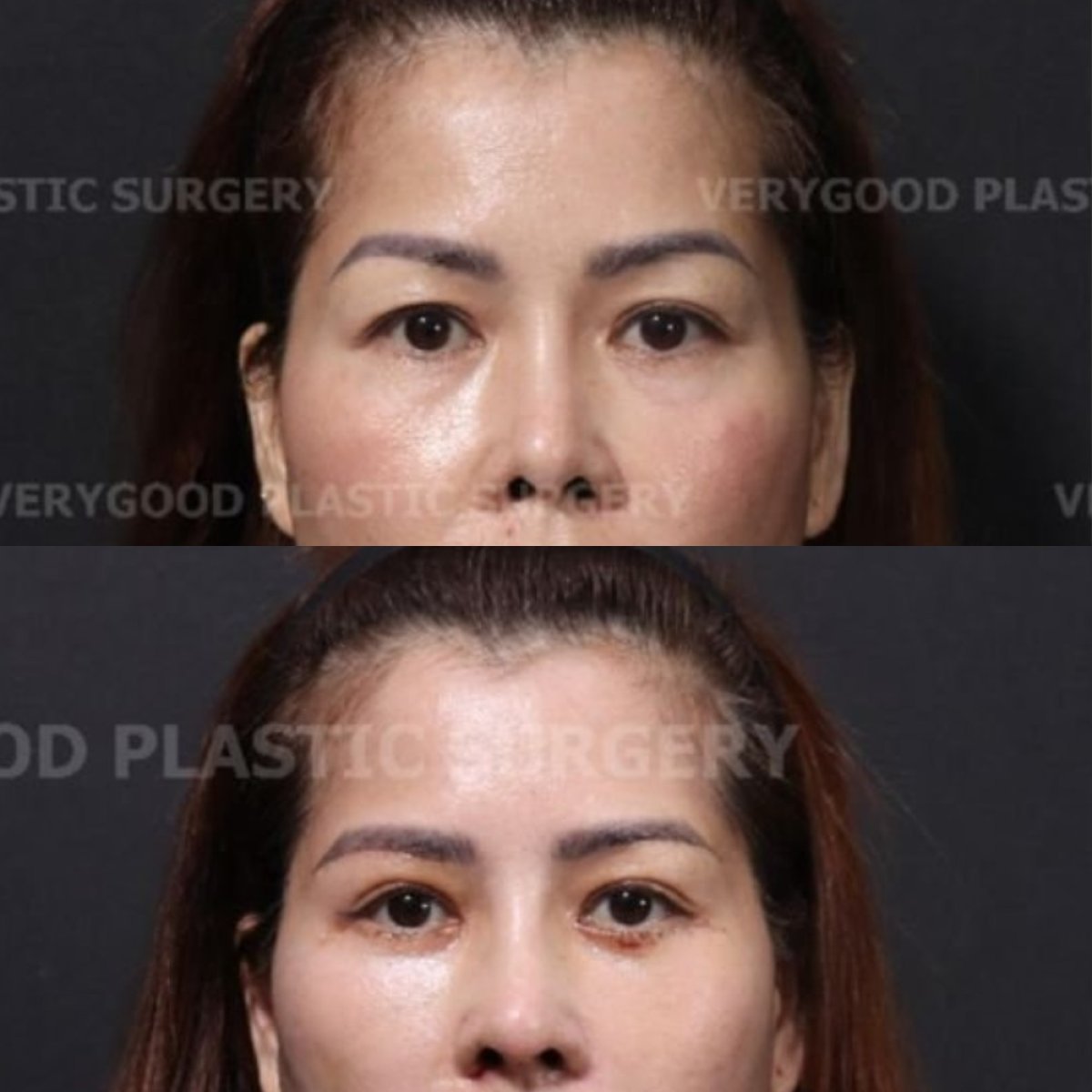 قبل وبعد زراعة الخدود في VG Plastic Surgery، نتيجة تعزيز حجم وتحديد الخدود