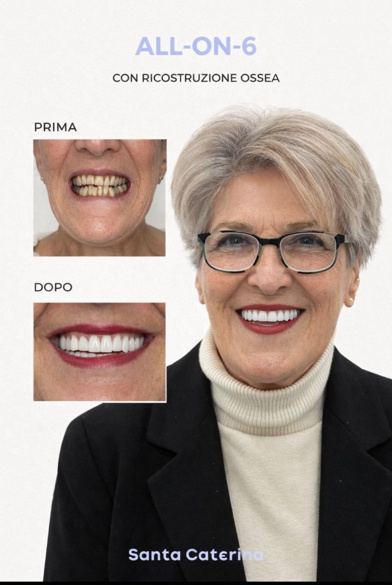 Before and after full-arch implant dentures result at Santa Caterina Clinic, improved smile