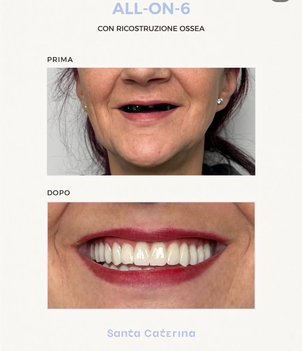 Before and after full-arch implant-fixed dentures result at Santa Caterina Clinic Dental