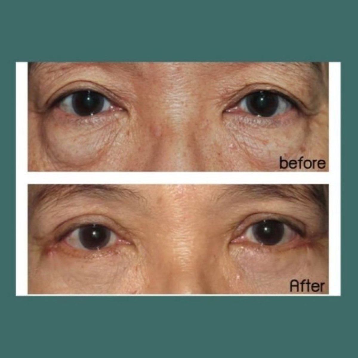 Resultados de blefaroplastia de párpado inferior antes y después en ID Clinic Bangkok