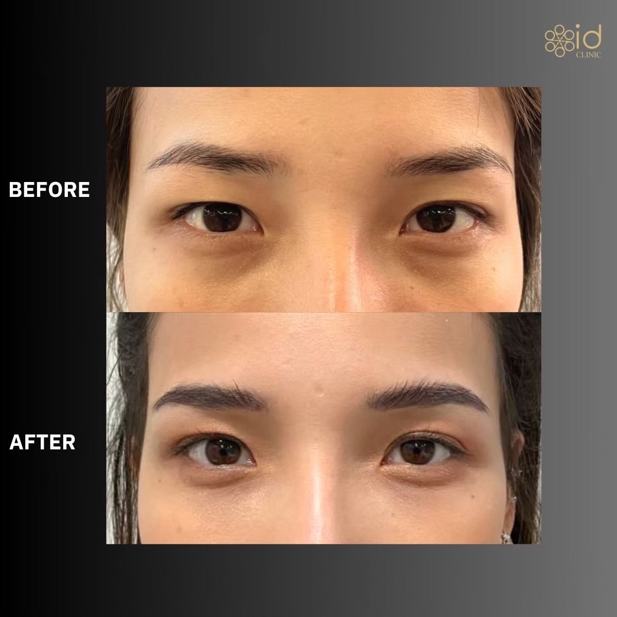 Resultados de blefaroplastia superior antes y después en ID Clinic Bangkok, ojos mejorados