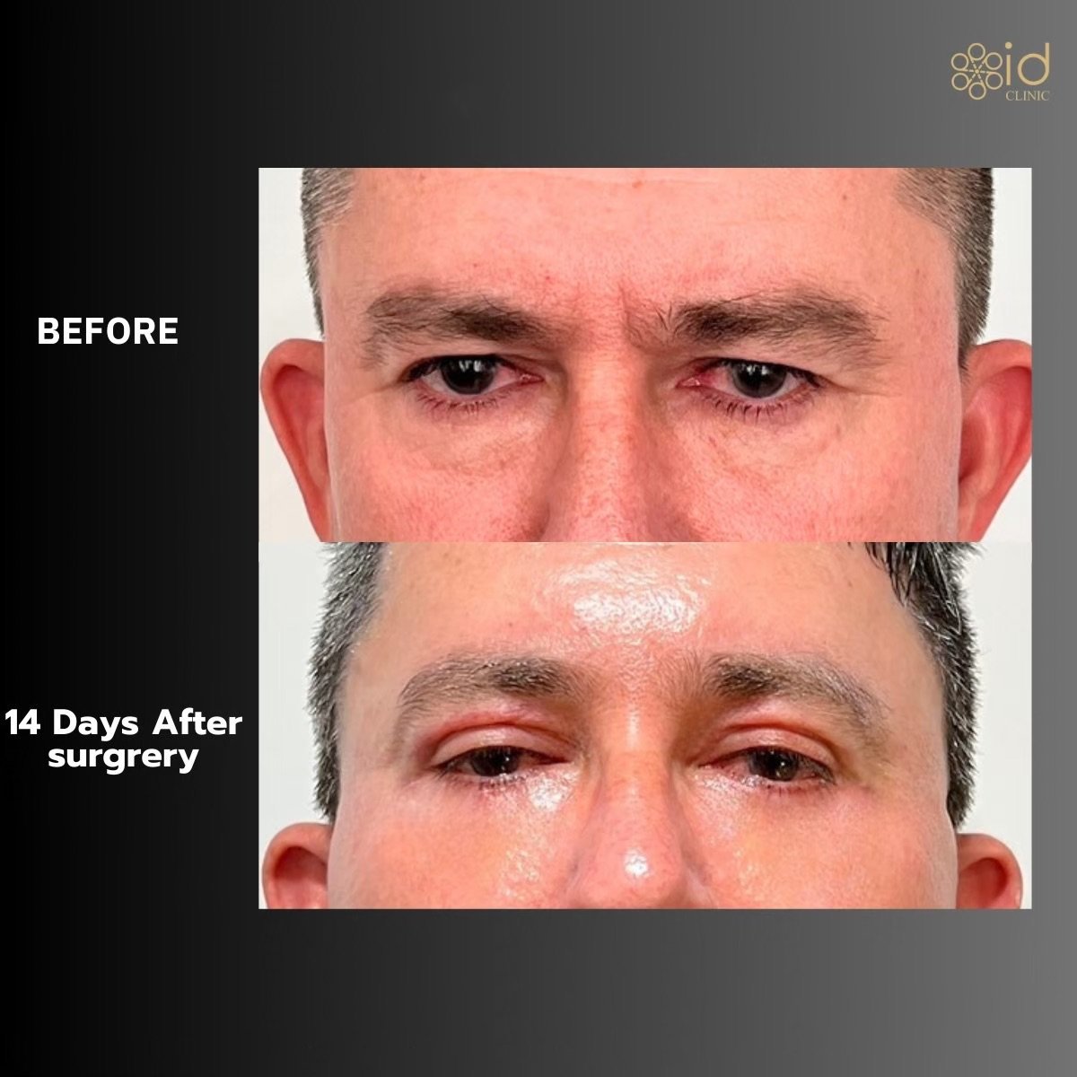 Resultados de blefaroplastia superior antes y después en ID Clinic Bangkok, 14 días tras cirugía
