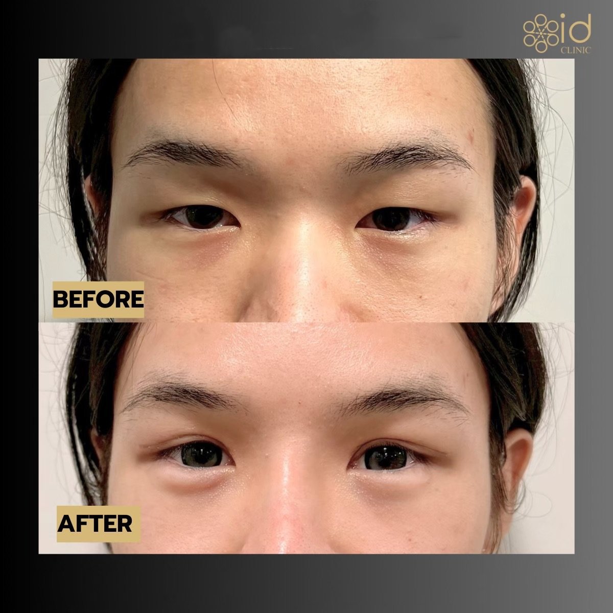 Resultados de blefaroplastia superior antes y después en ID Clinic Bangkok, contorno mejorado