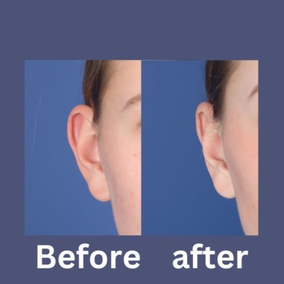 Before and after otoplasty results at ID Clinic Bangkok, improved ear shape and position