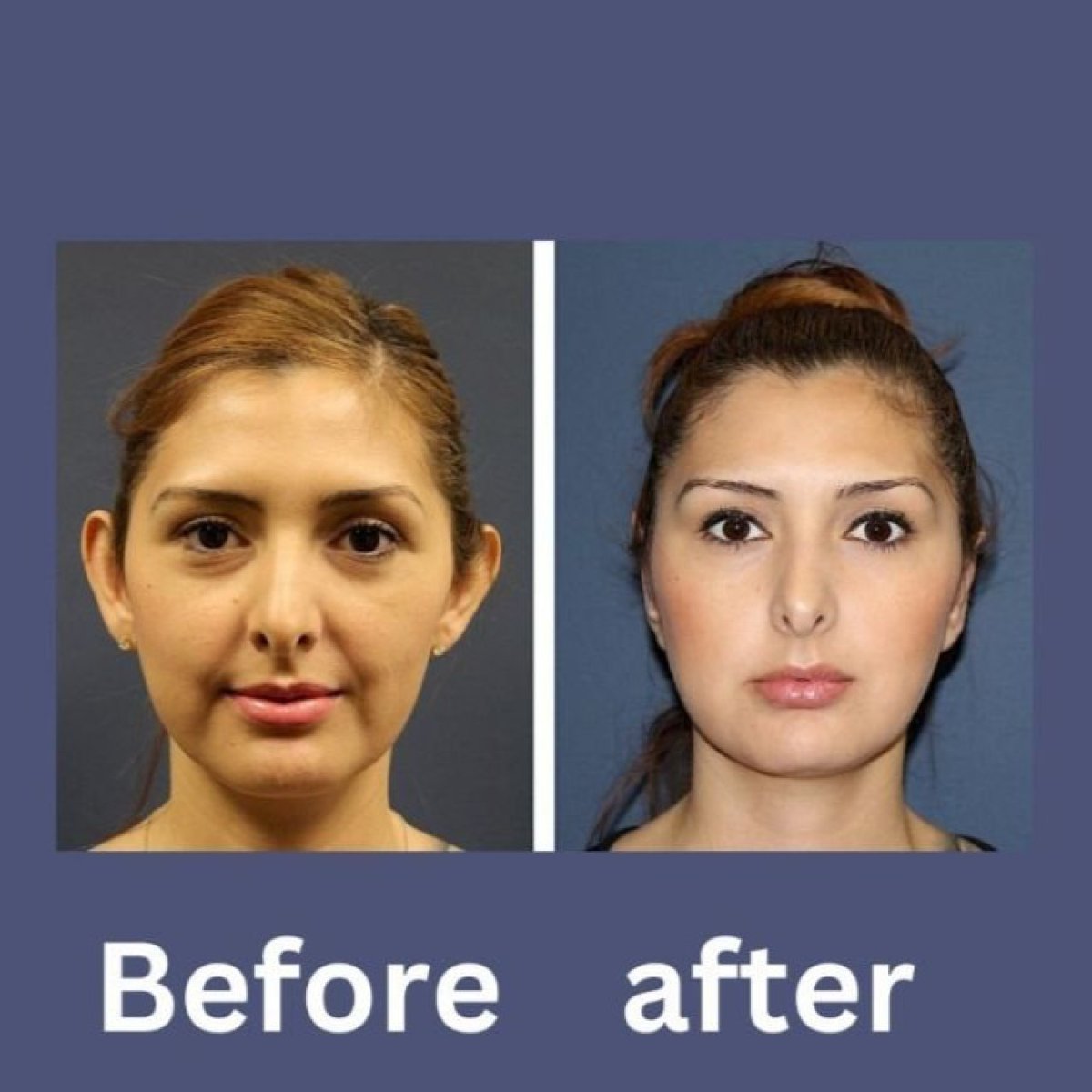 Результати отопластики до і після в ID Clinic Bangkok, помітне покращення форми вух
