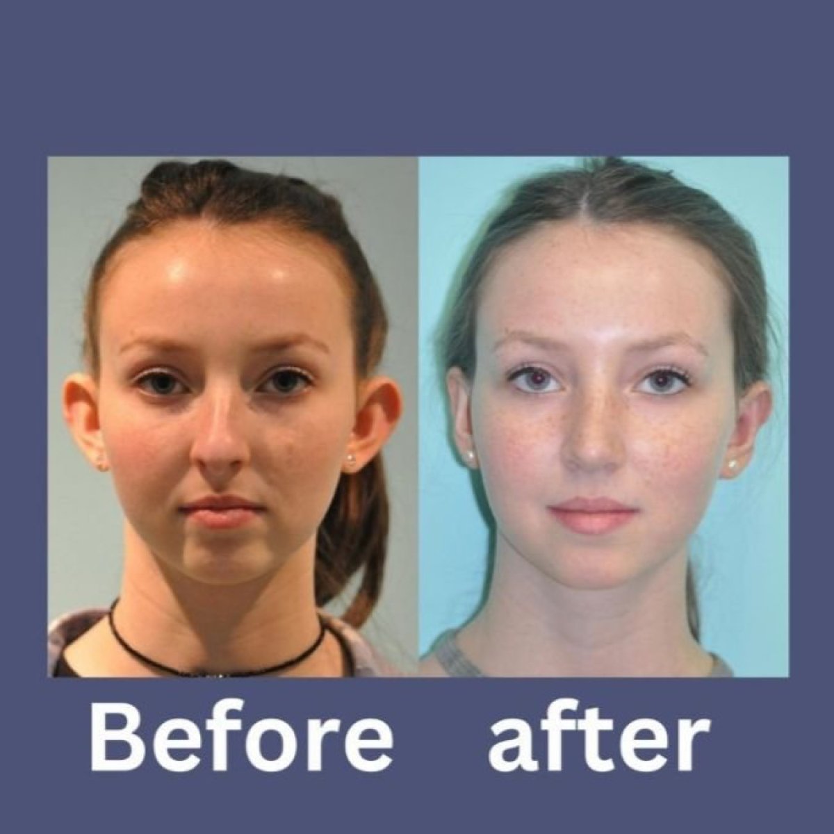 نتائج عملية تجميل الأذن قبل وبعد في ID Clinic Bangkok، تصحيح طبيعي للأذن