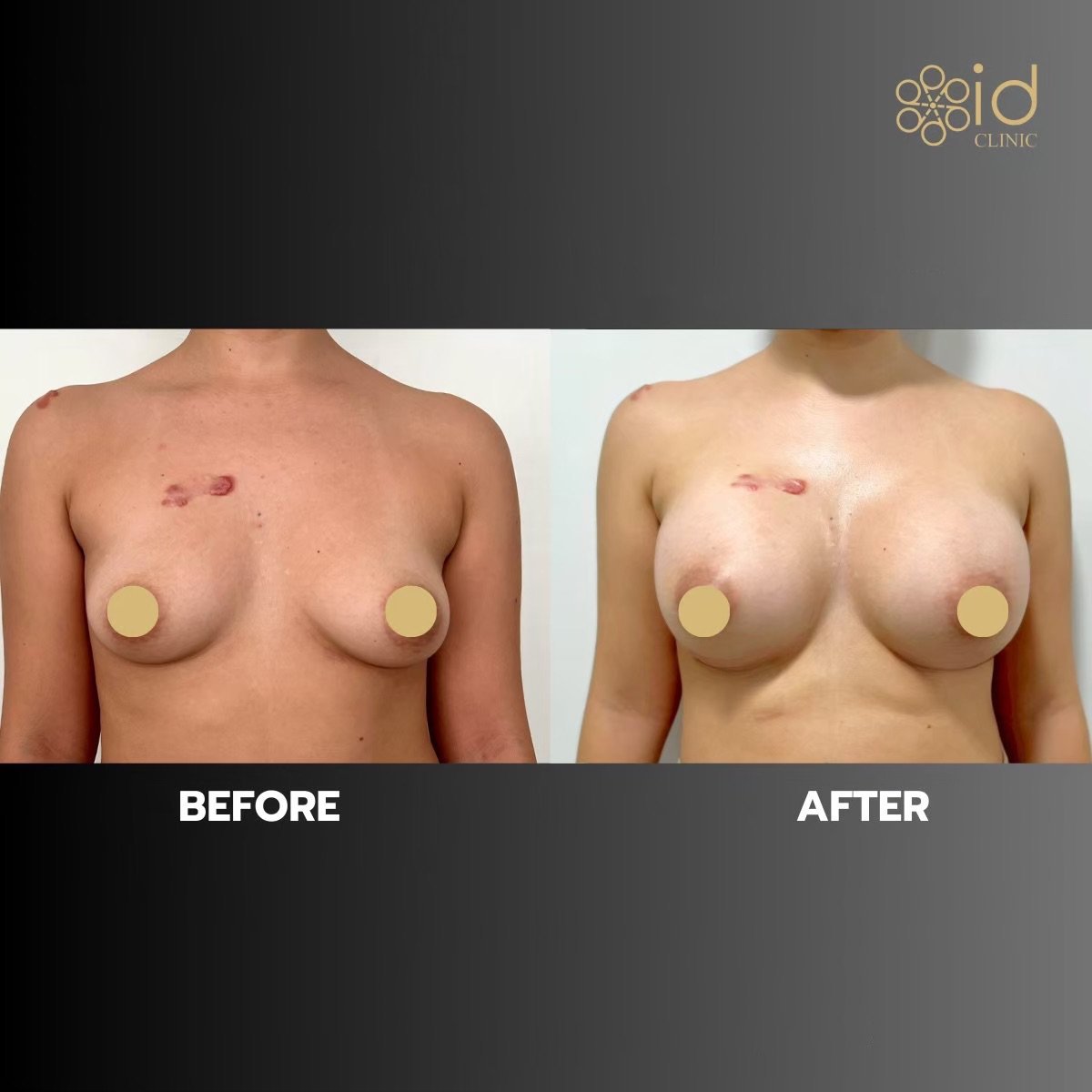 Before and after breast augmentation with silicone implants at ID Clinic Bangkok, visible results
