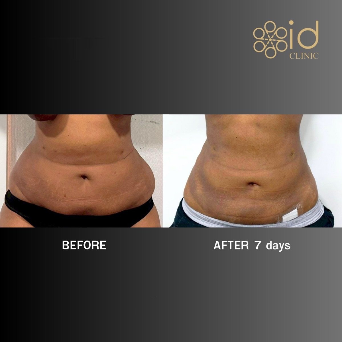 Resultados de Vaser liposucción antes y después en ID Clinic Bangkok, cintura más delgada tras 7 días