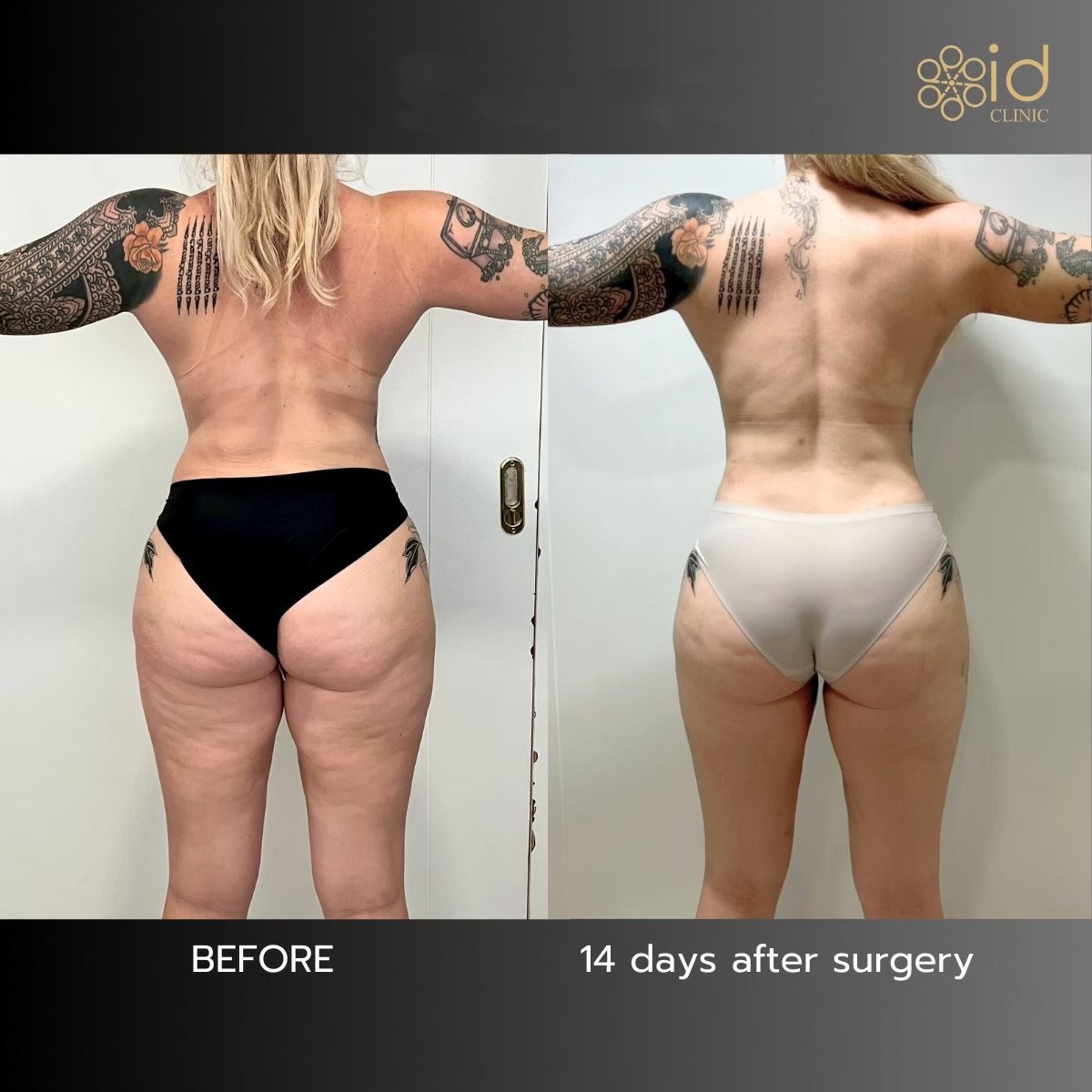 Before and after Vaser liposuction results at ID Clinic Bangkok, visible body contouring