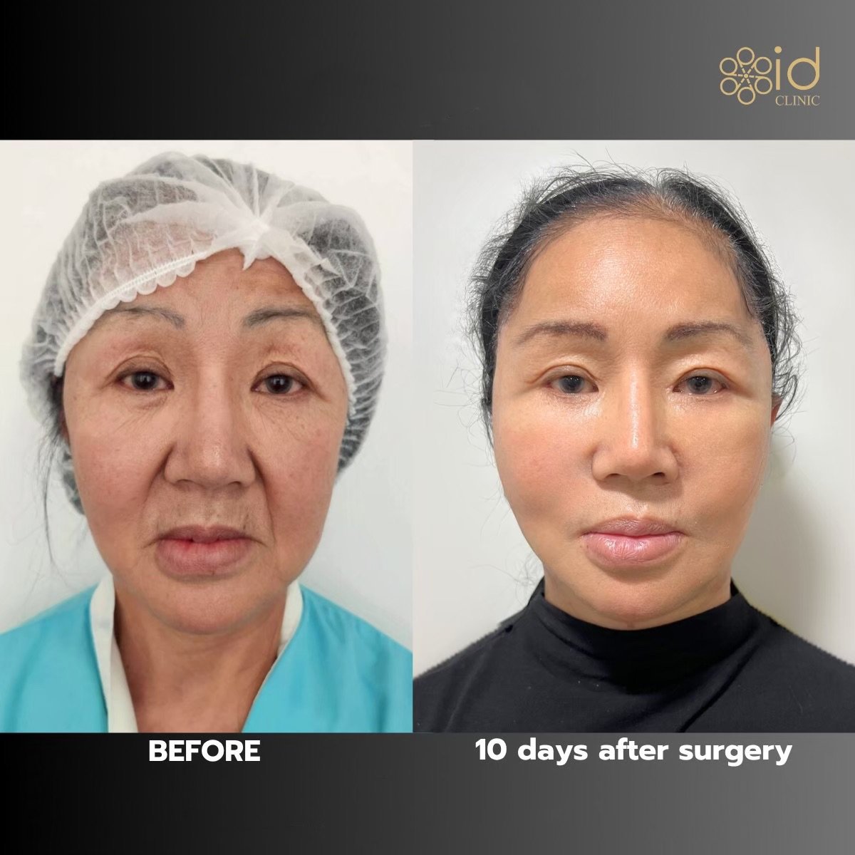 Resultados de lifting facial antes y después en ID Clinic Bangkok, rejuvenecimiento en 10 días