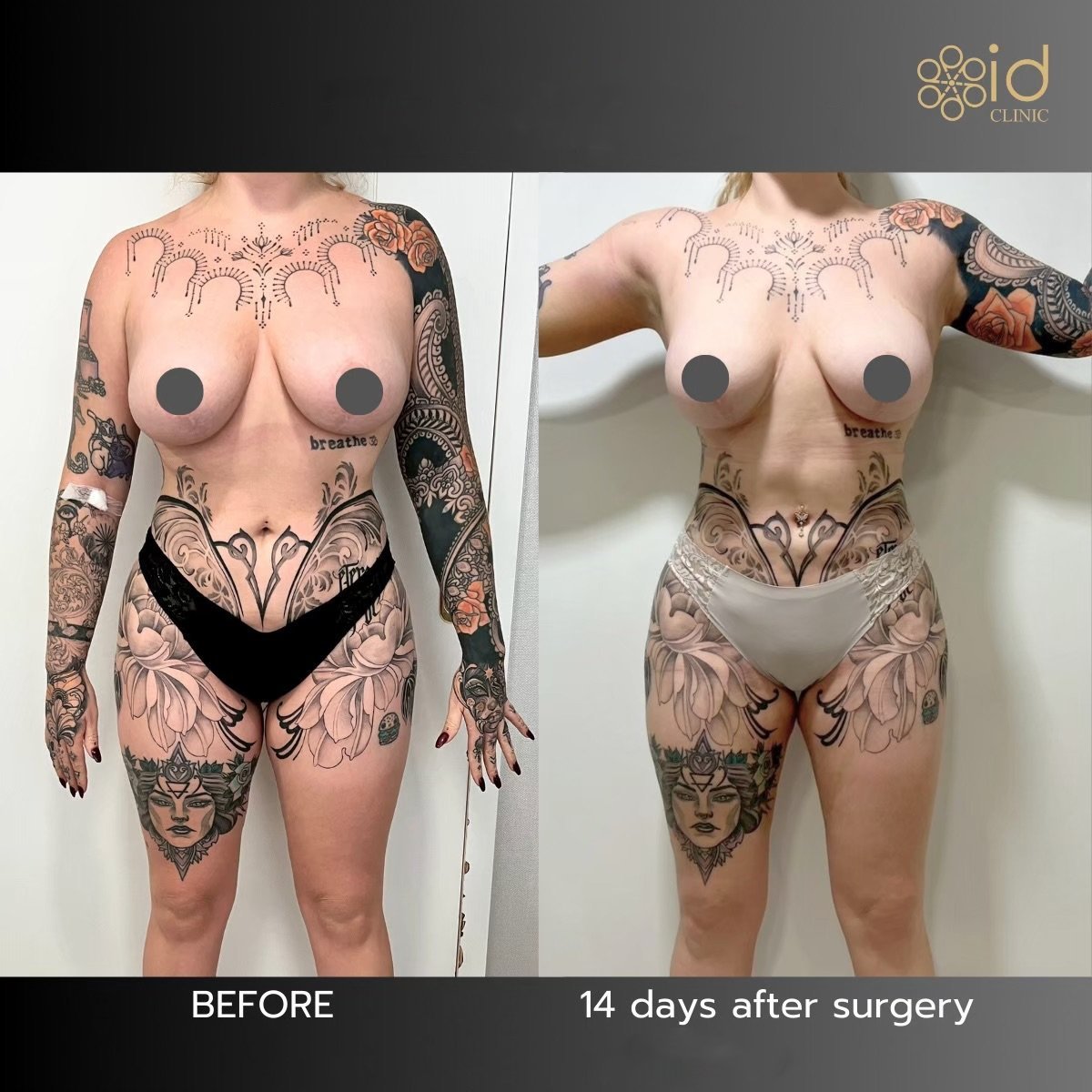 Resultados de liposucción 360 antes y después en ID Clinic Bangkok, mejora visible de la cintura
