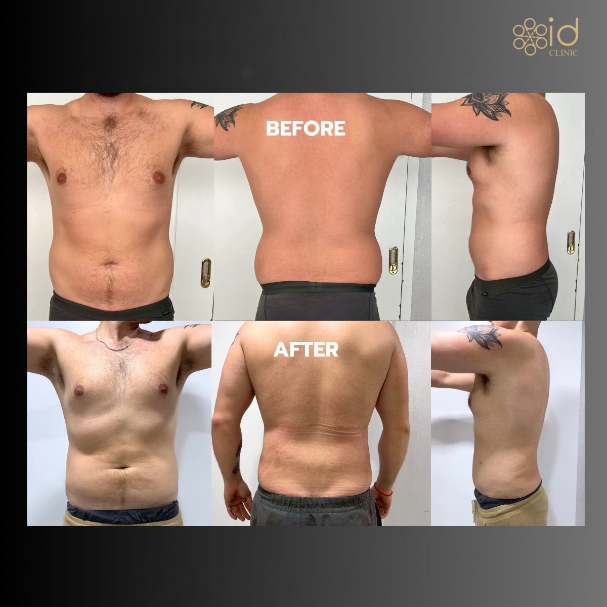 نتائج شفط الدهون 360 قبل وبعد في ID Clinic Bangkok مع تحسين واضح لتناسق الجسم