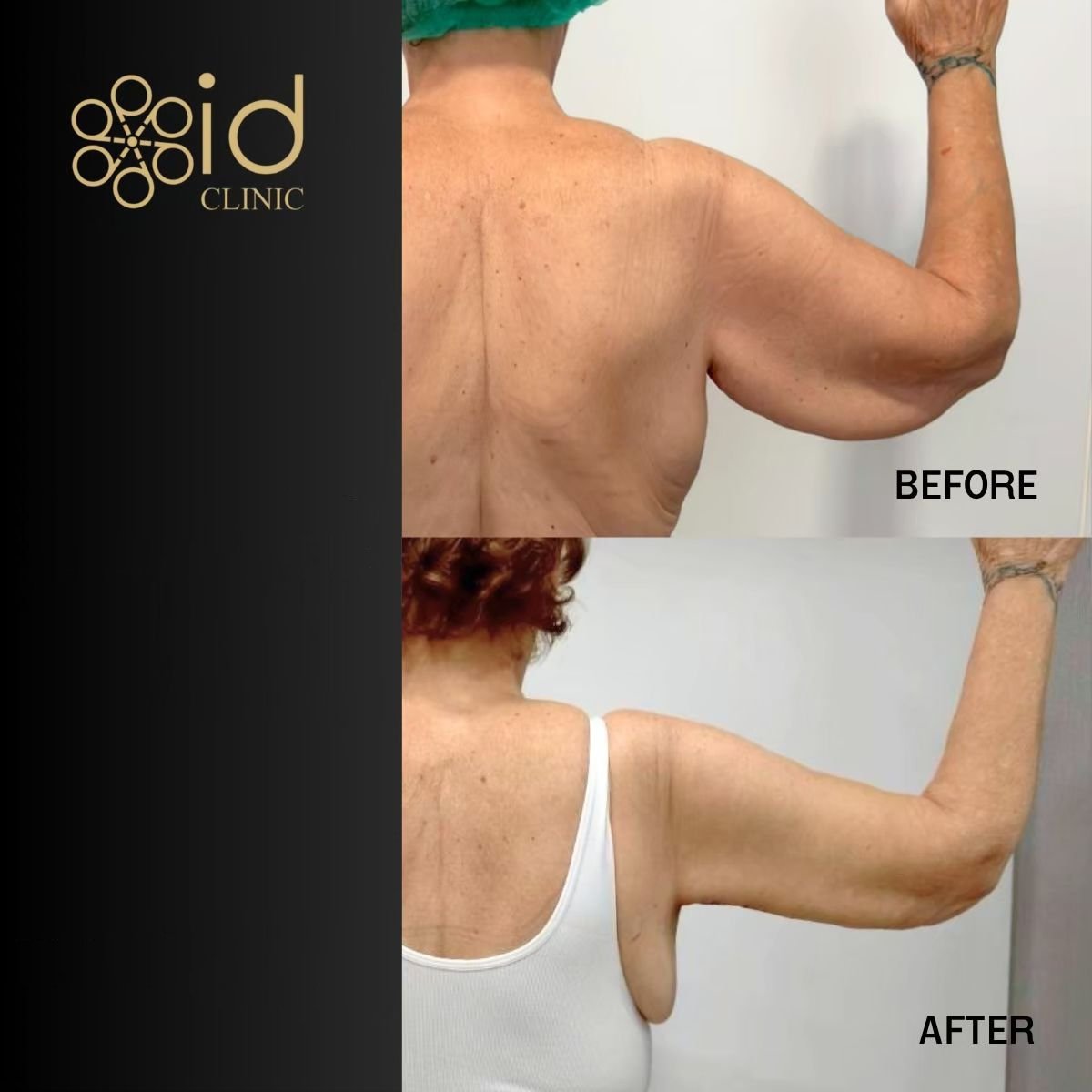 Resultados de lifting de brazos antes y después en ID Clinic Bangkok, mejor contorno tras braquioplastia