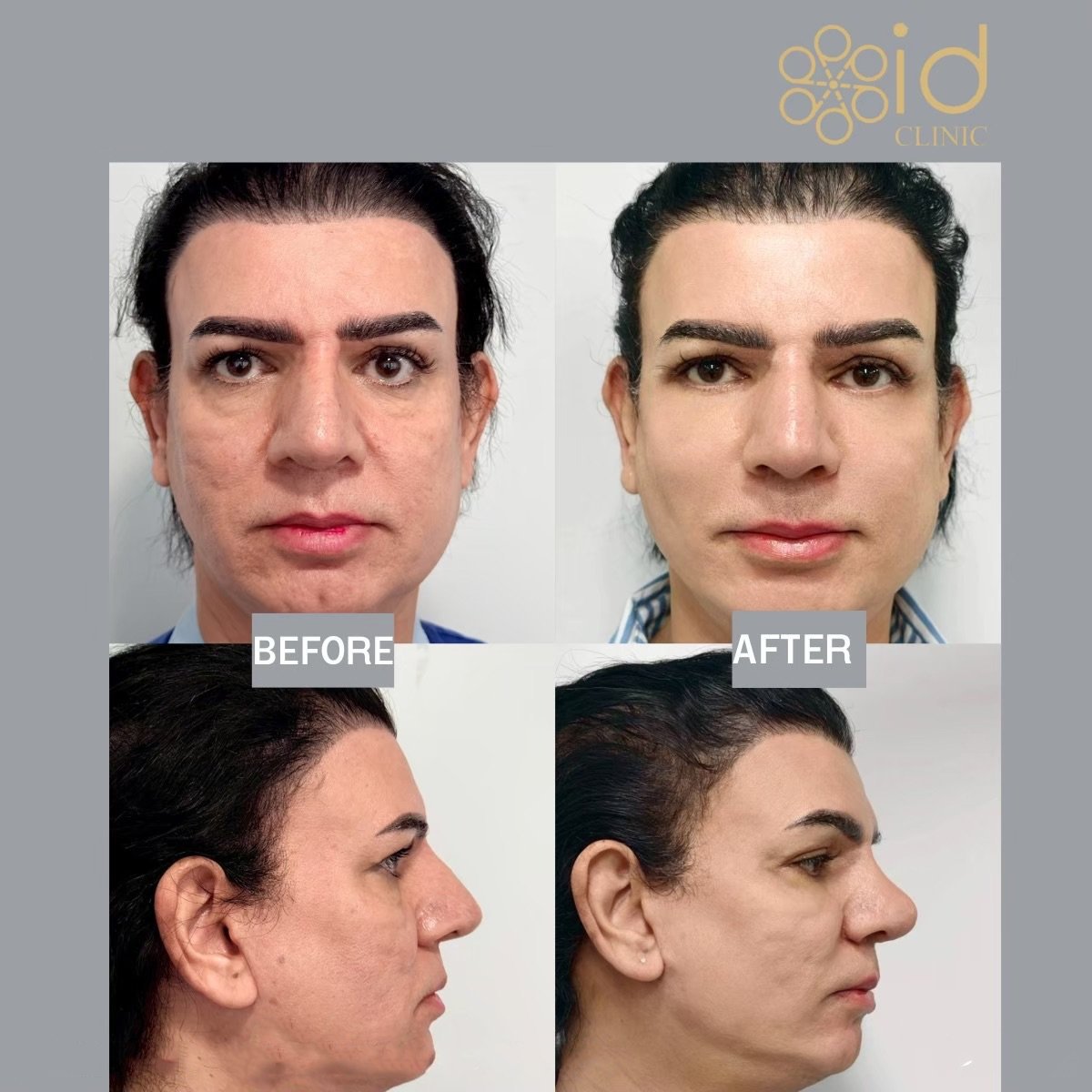 نتائج قبل وبعد عملية تصحيح الحاجز الأنفي في ID Clinic Bangkok، تحسن تماثل الأنف والتنفس