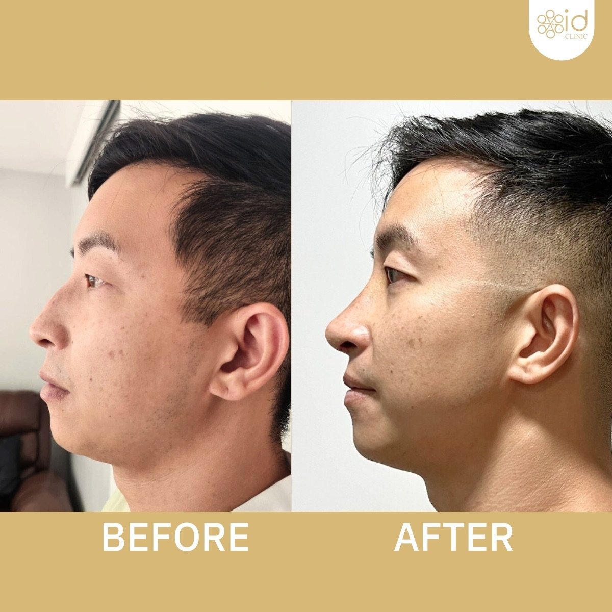 نتائج تجميل الحاجز الأنفي قبل وبعد في ID Clinic Bangkok، تحسين شكل ووظيفة الأنف