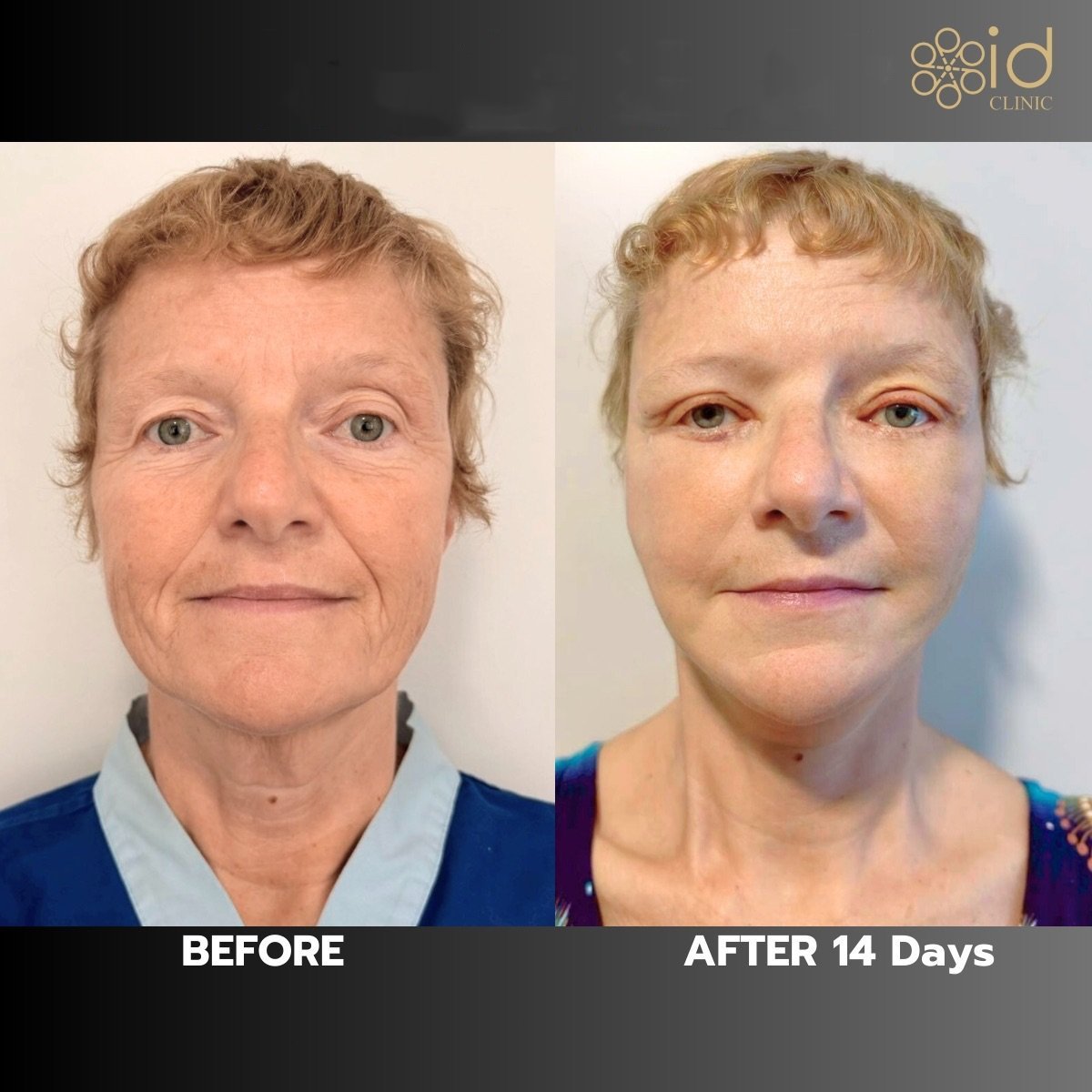 Resultados de blefaroplastia antes y después en ID Clinic Bangkok, corrección de párpados tras 14 días