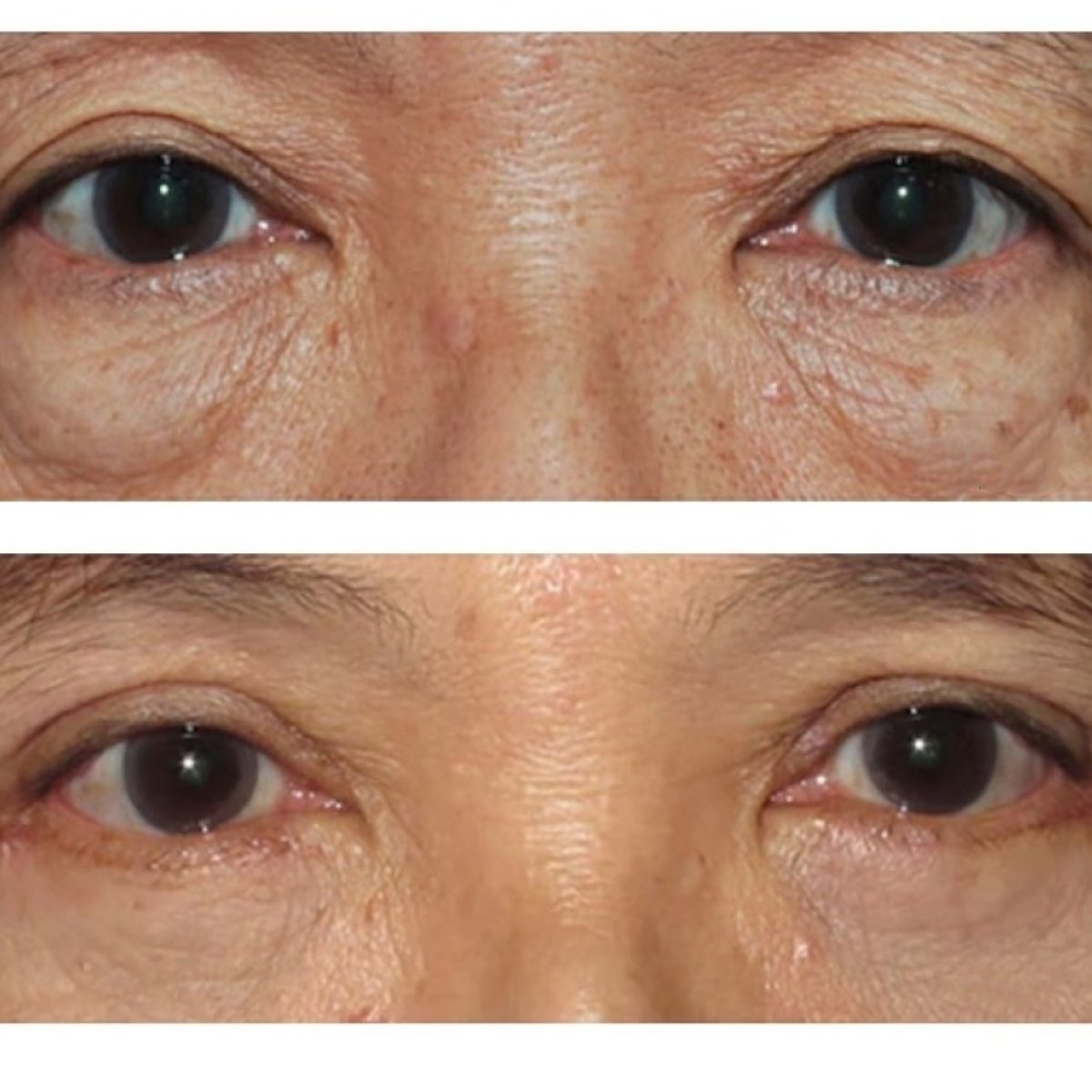 Resultados de cirugía de párpados superior e inferior en ID Clinic Bangkok, ojos rejuvenecidos