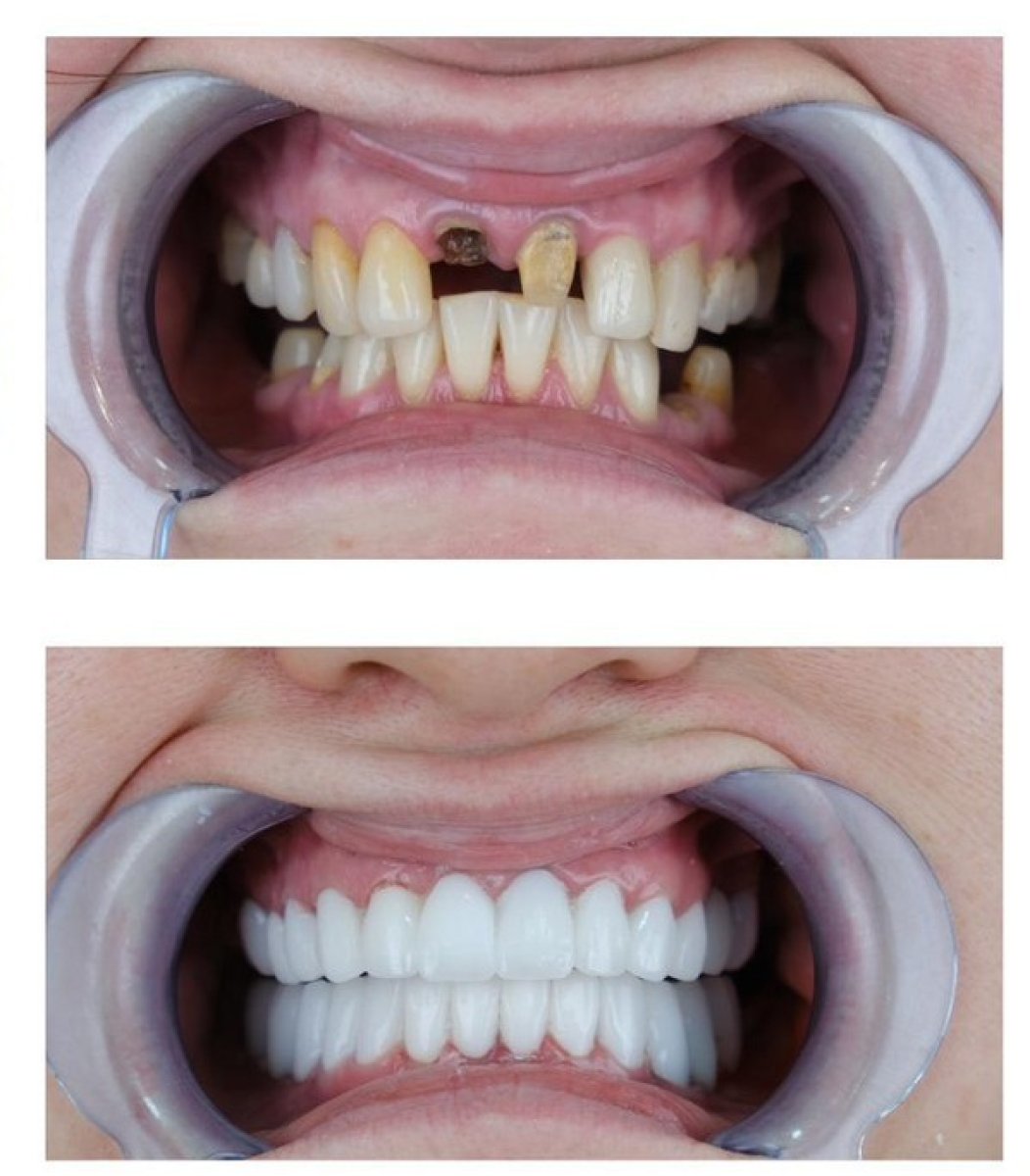 Before and after result of Same day All-on-4 dental implants, full smile restoration