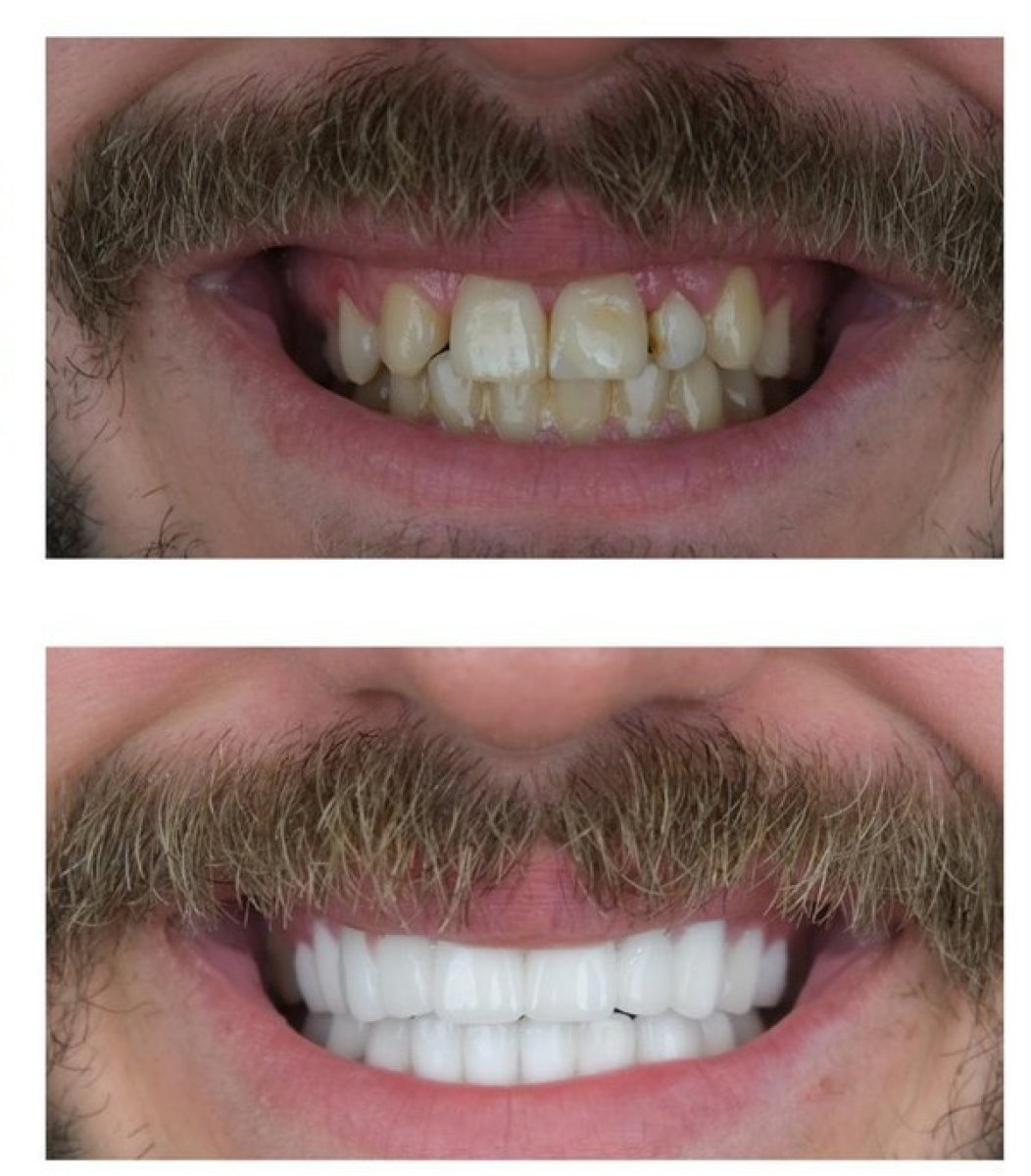 Результати до і після smile makeover – вирівнювання та відбілювання зубів