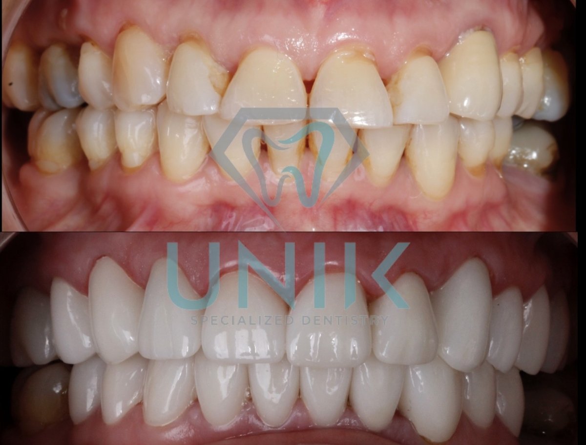 Resultados antes y después de smile makeover en UNIK Specialized Dentistry – transformación con carillas