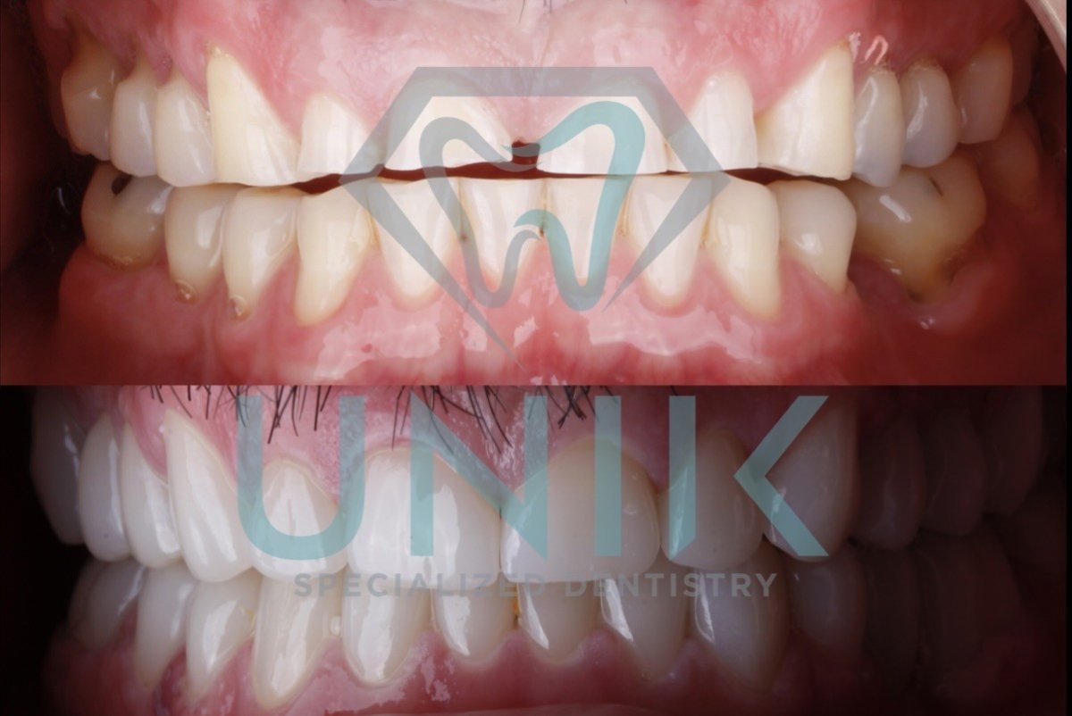 Resultados de antes y después de smile makeover en UNIK Specialized Dentistry – alineación dental