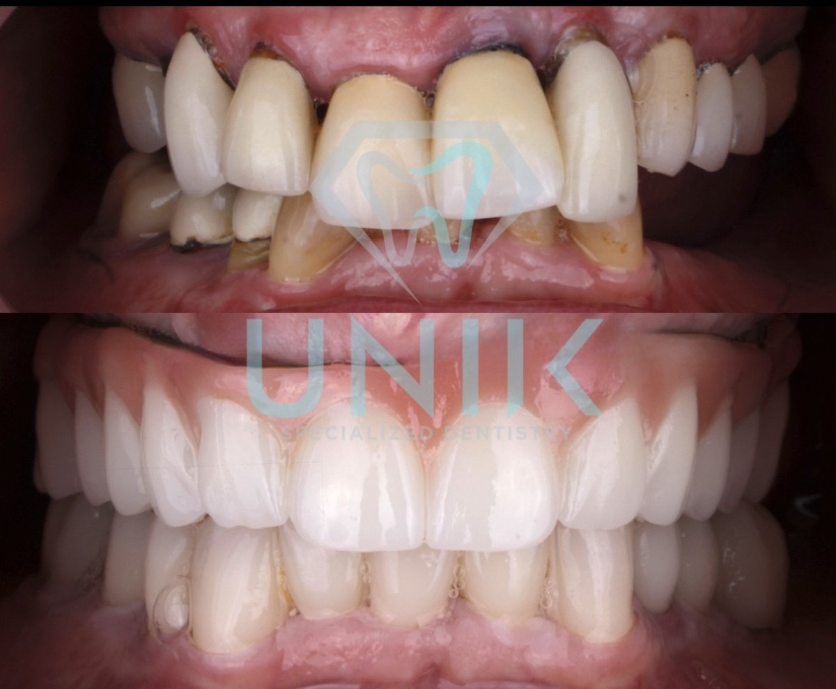 Resultados antes y después de puente implantológico en UNIK Specialized Dentistry – sonrisa restaurada