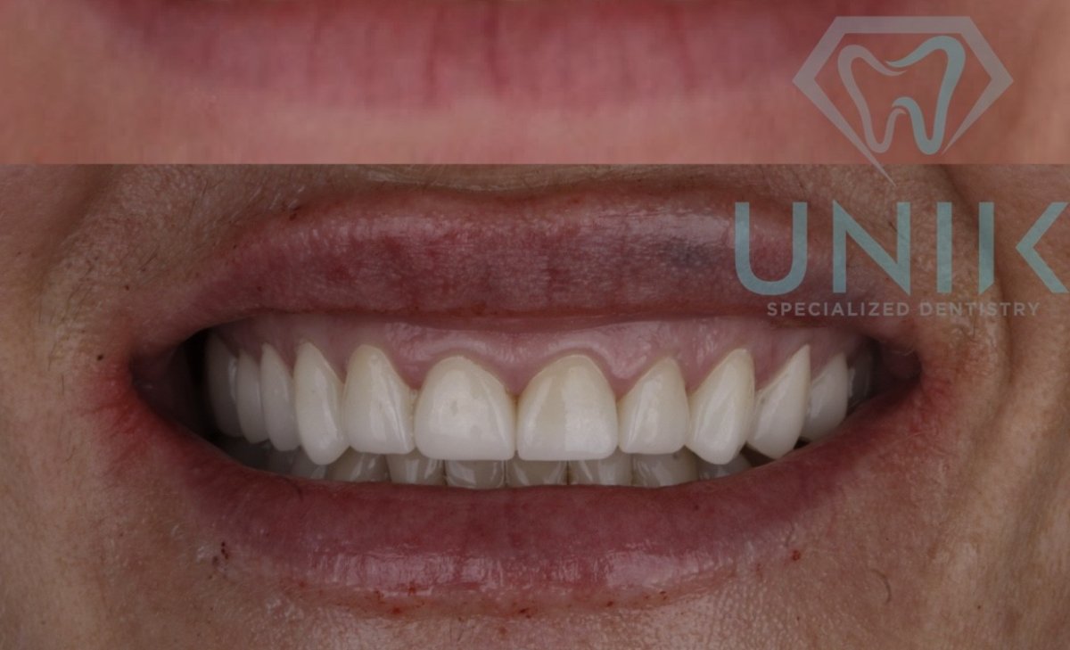 تحول الابتسامة بعد قشور الأسنان في عيادة UNIK Specialized Dentistry، النتيجة