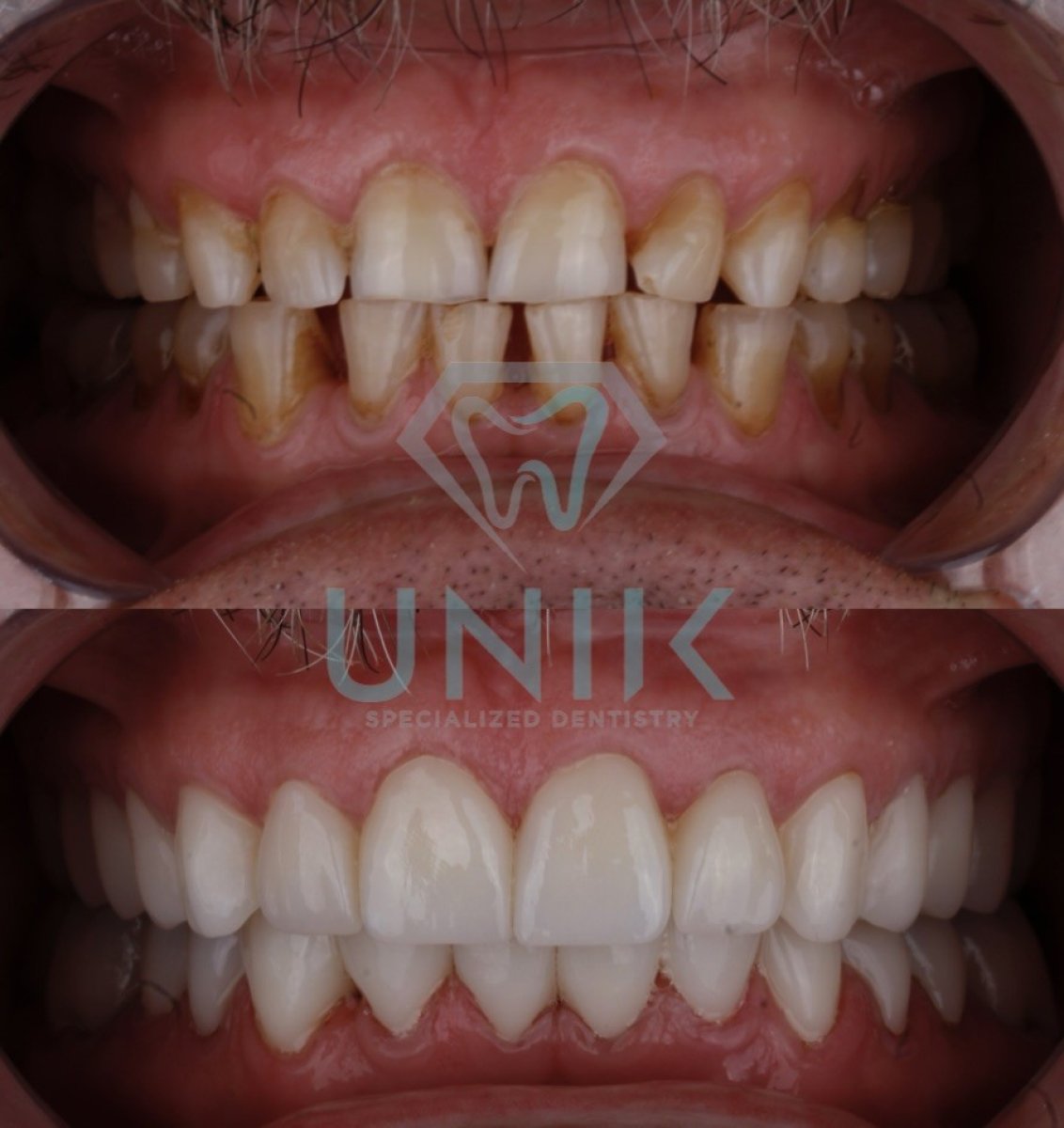 نتائج قبل وبعد الفينير في UNIK Specialized Dentistry – تحول الابتسامة