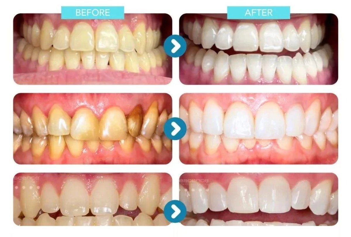 Before and after tooth whitening results – visibly whiter teeth after dental procedure