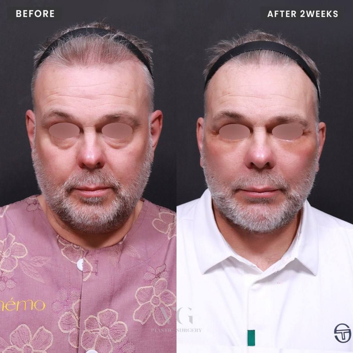 نتائج شد الوجه العميق قبل وبعد في VG Plastic Surgery، تجديد شباب الوجه بوضوح