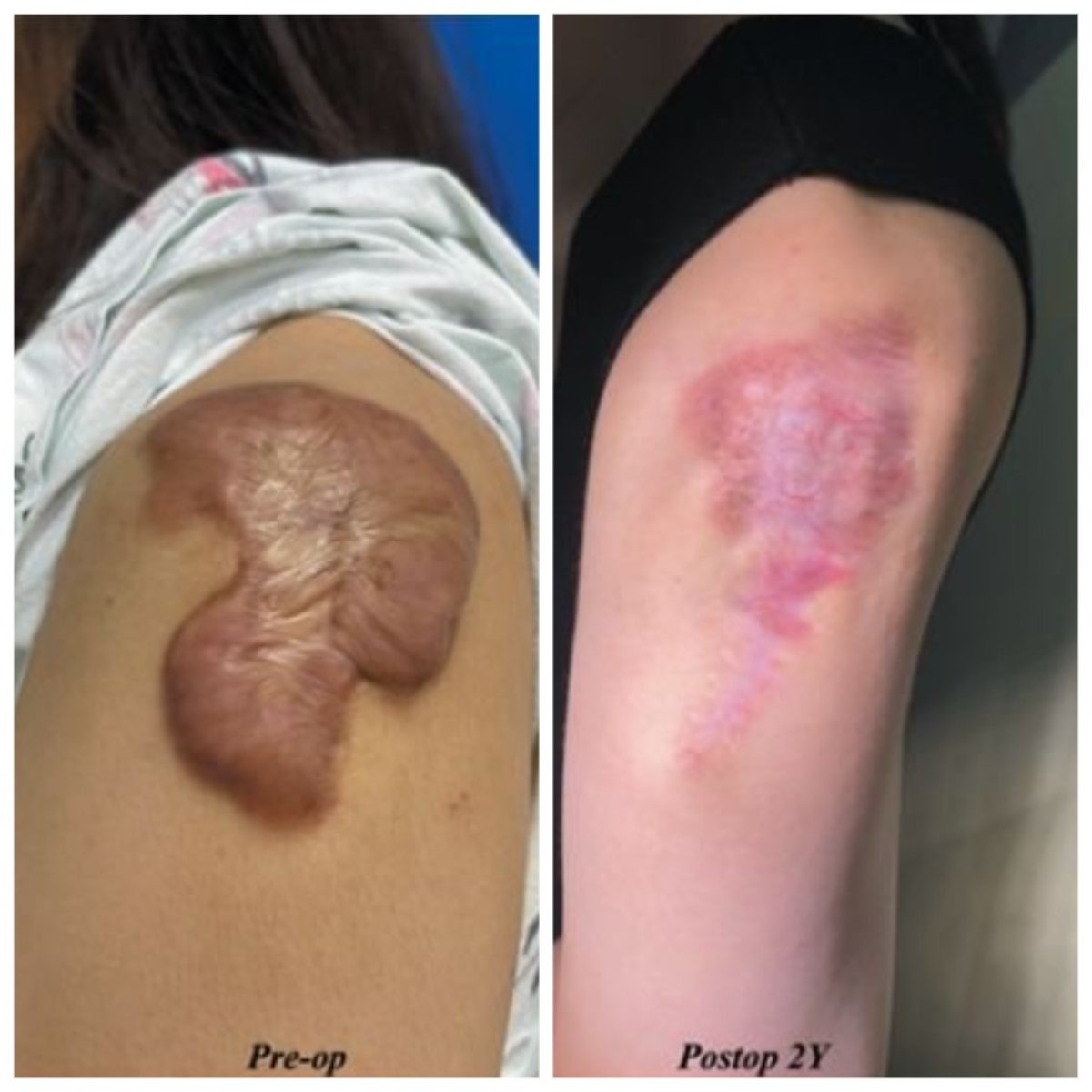 Avant-après greffe de peau pour brûlures au bras à Xiamen Humanity Hospital, cicatrice améliorée