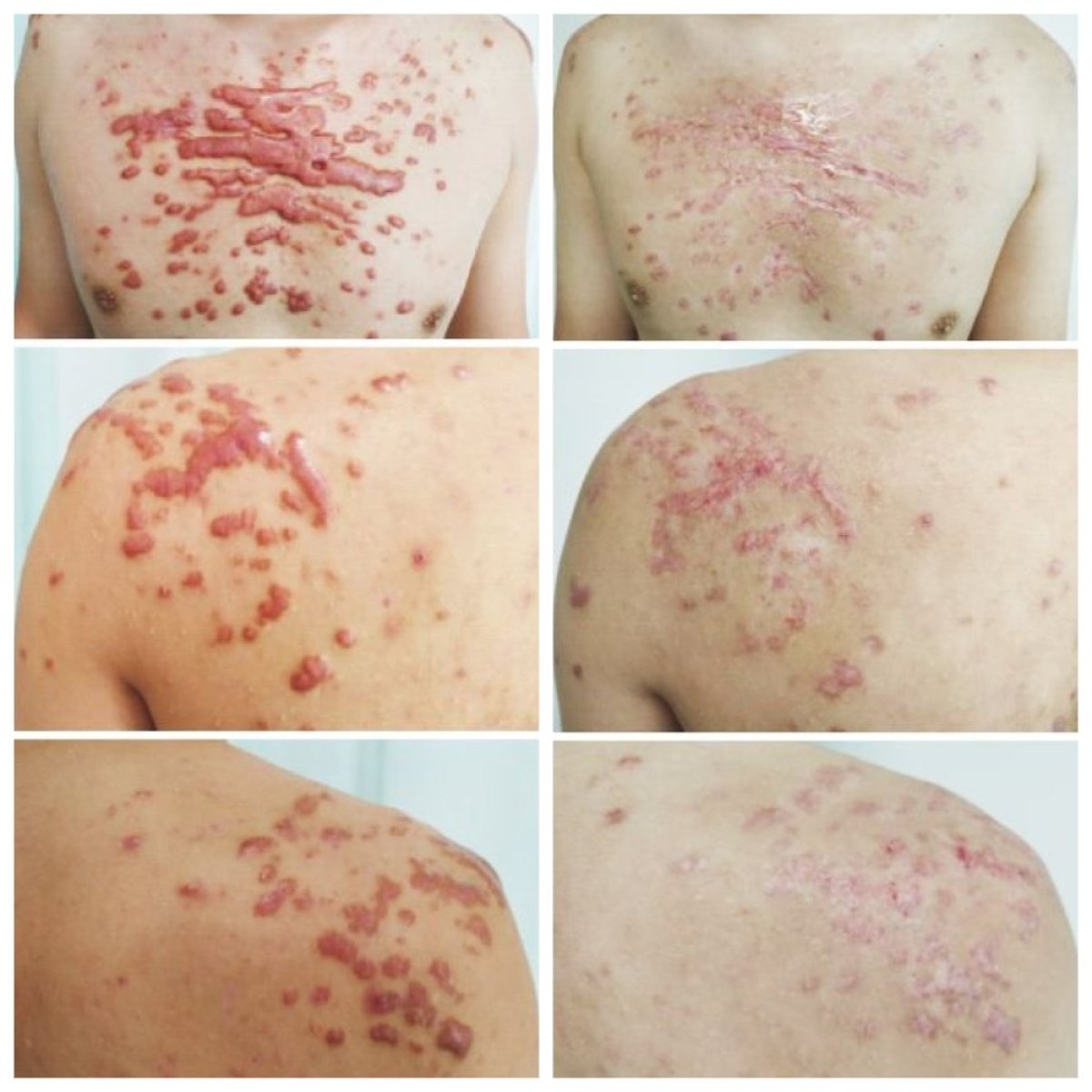 Antes y después de injerto de piel por quemaduras en Xiamen Humanity Hospital, reducción de cicatrices