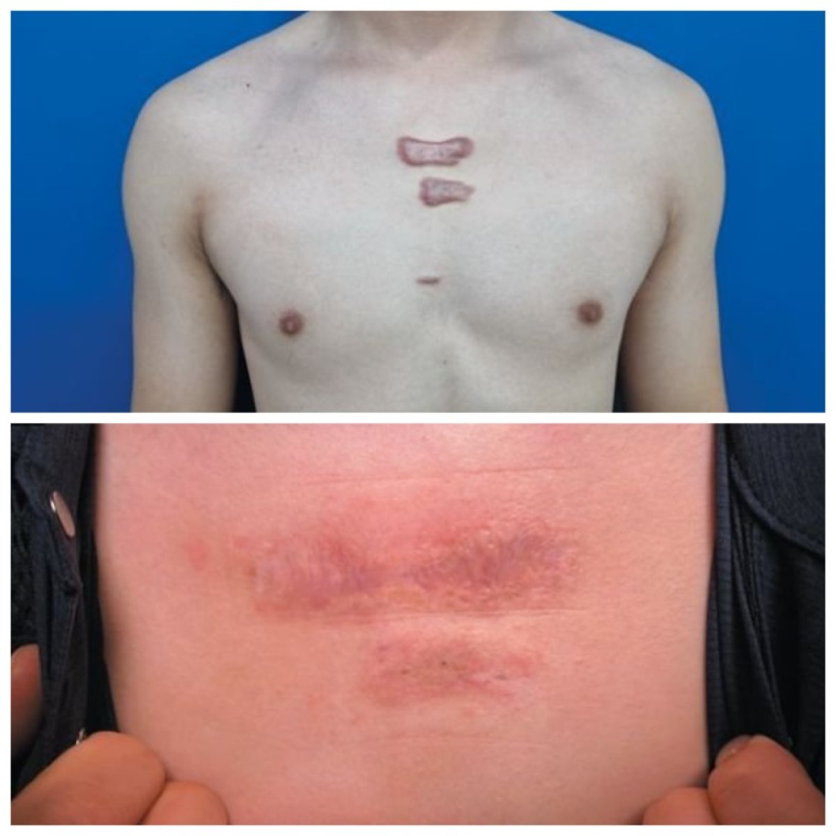 Resultados antes y después de injerto de piel por quemaduras en el pecho en Xiamen Humanity Hospital