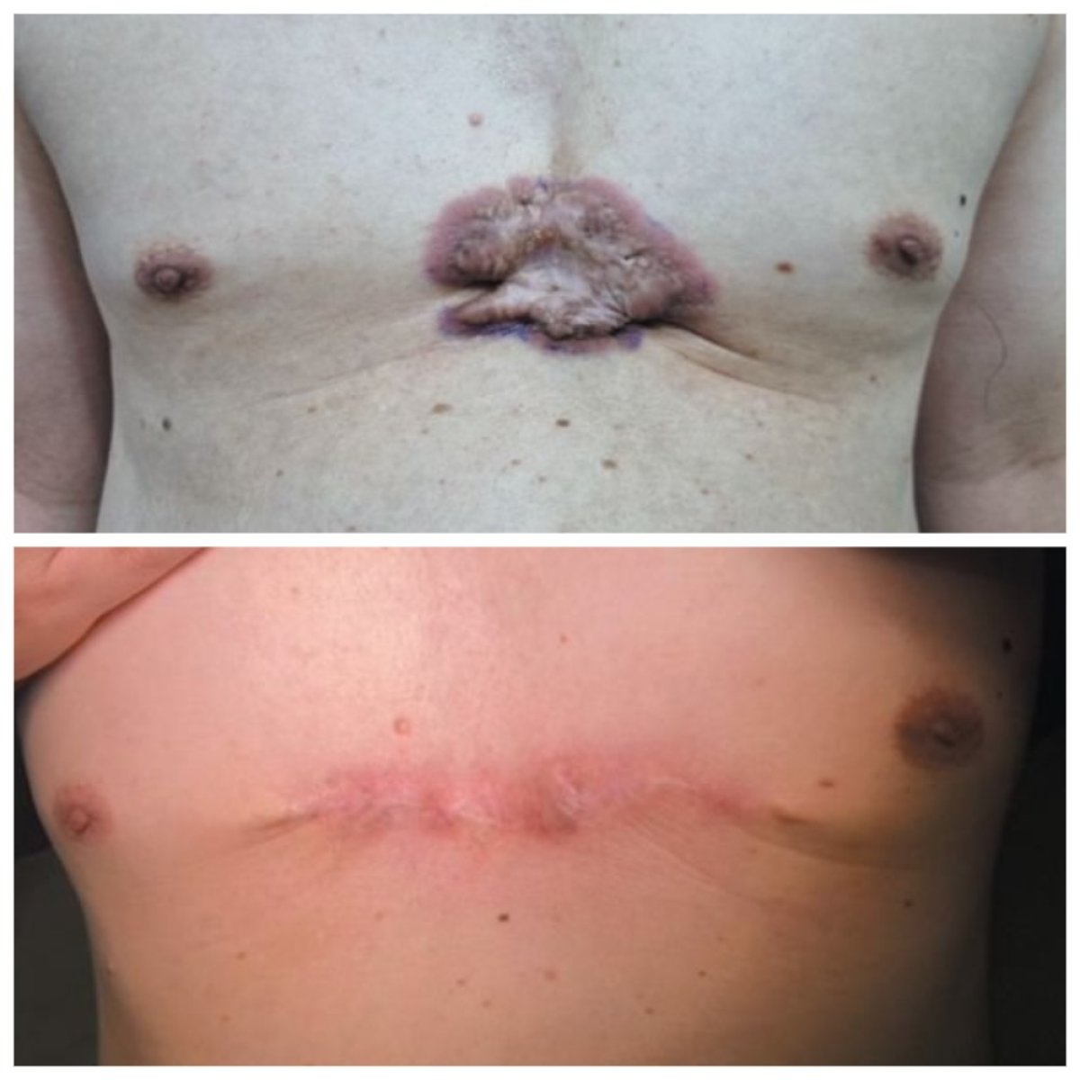 Resultados antes y después de injerto de piel por quemaduras en el pecho en Xiamen Humanity Hospital