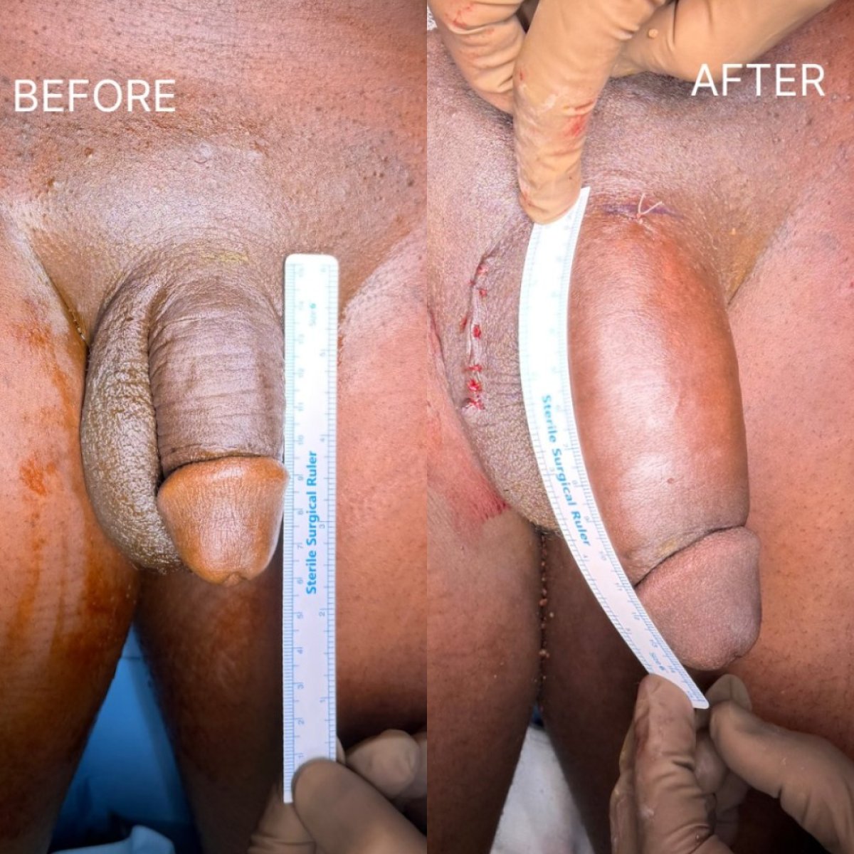 نتائج تكبير القضيب قبل وبعد في Safe Urology Clinic، زيادة واضحة في الحجم