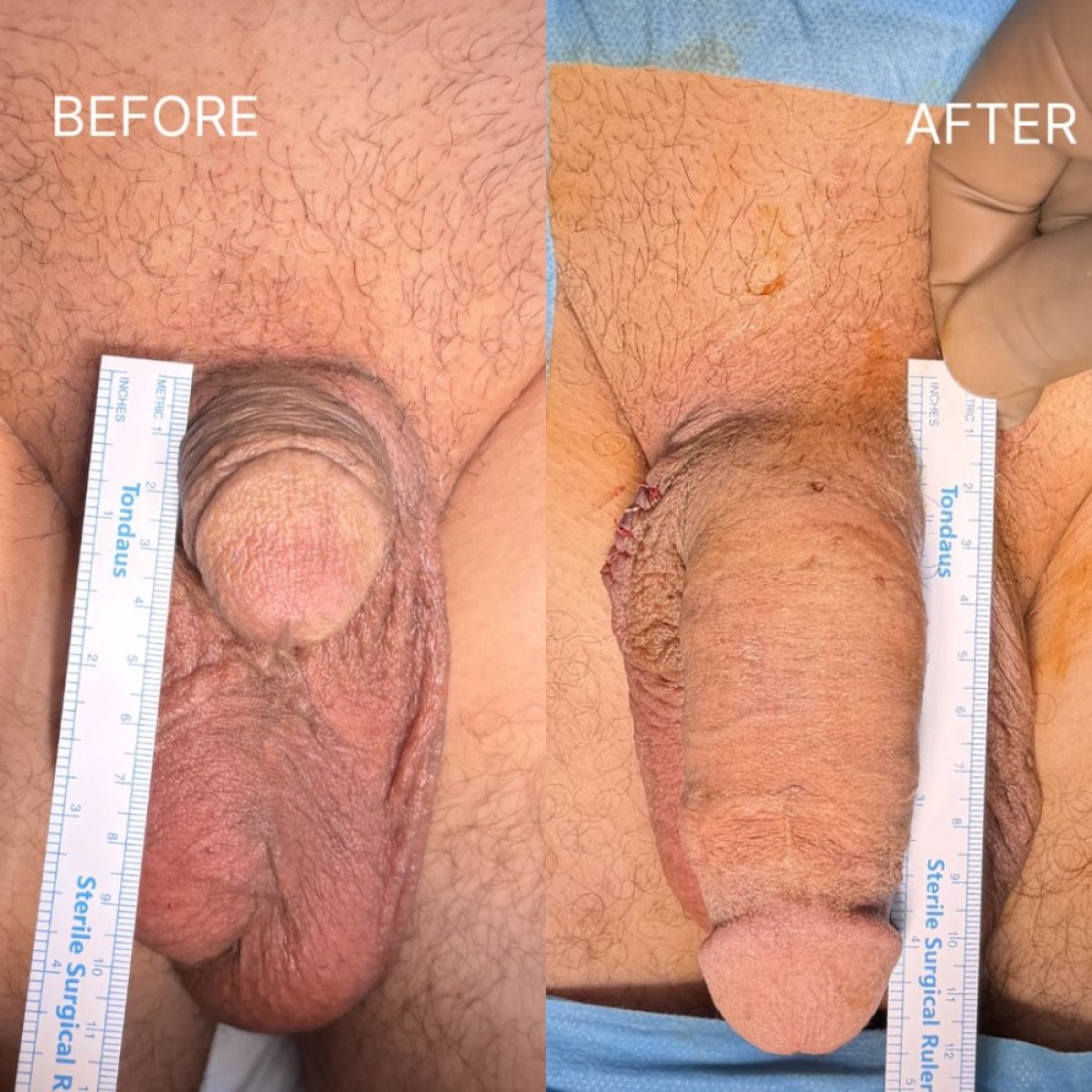 نتائج تكبير القضيب قبل وبعد في Safe Urology Clinic مع زيادة واضحة بالطول
