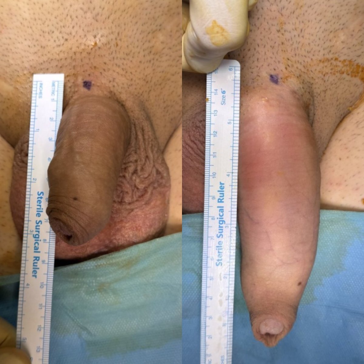 نتائج تكبير القضيب قبل وبعد في Safe Urology Clinic، زيادة واضحة في الطول