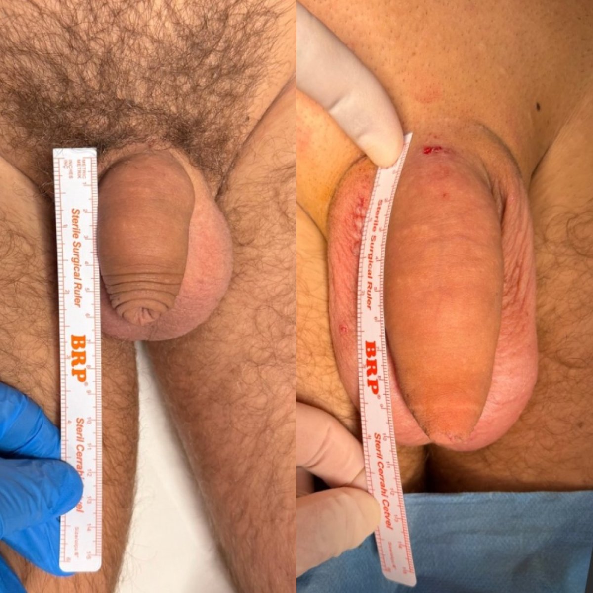 نتائج تكبير القضيب قبل وبعد في Safe Urology Clinic، زيادة واضحة في الطول