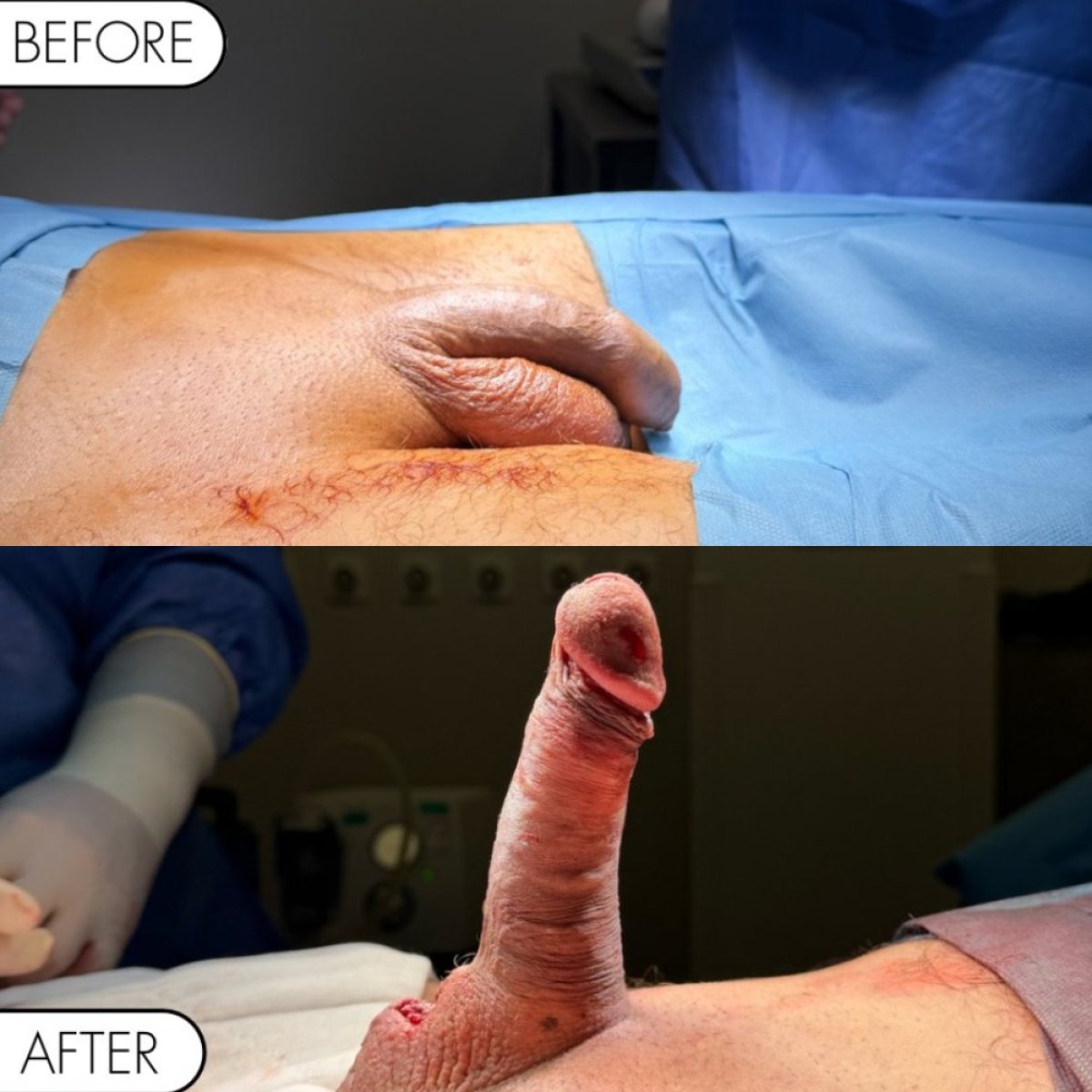 نتائج قبل وبعد زراعة دعامة القضيب في Safe Urology Clinic، تحسين الانتصاب